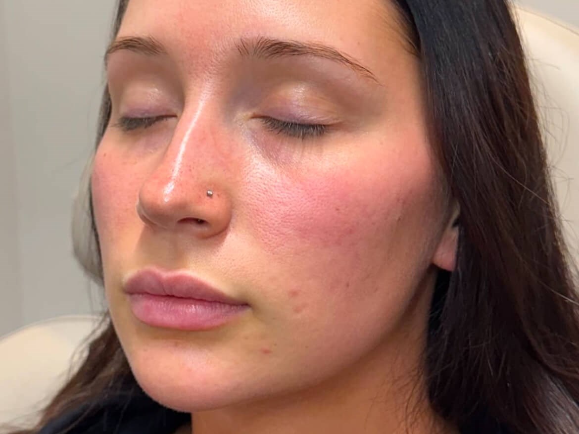 Enhancing Lips and Chin After