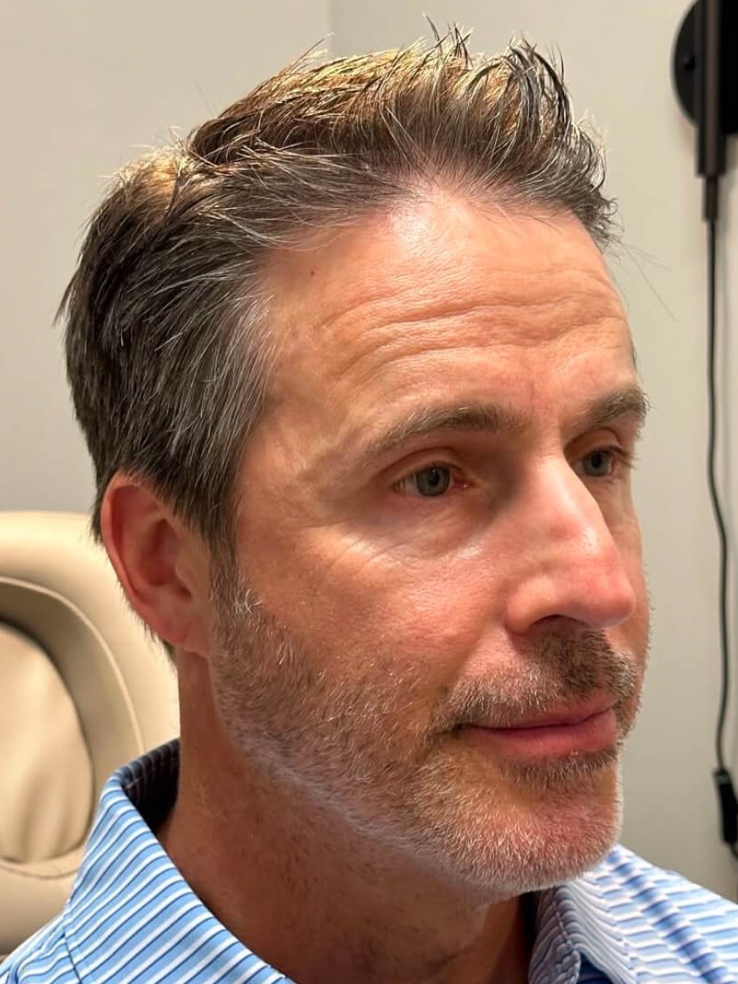 Restore Facial Volume at JEM Before