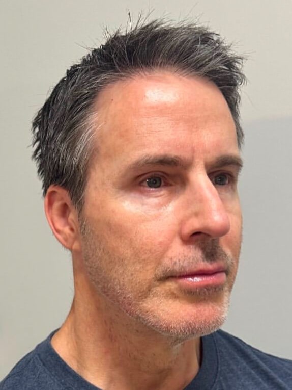 Restore Facial Volume at JEM After