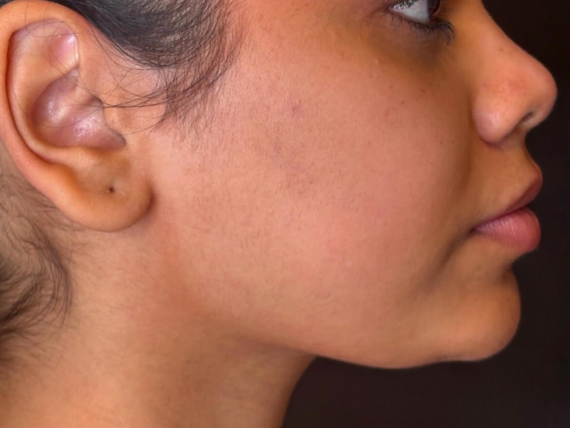Lift & Define your Jawline After