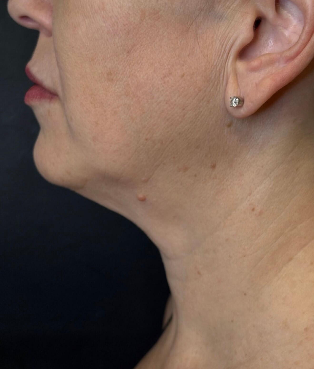 Smooth & Sculpted Before