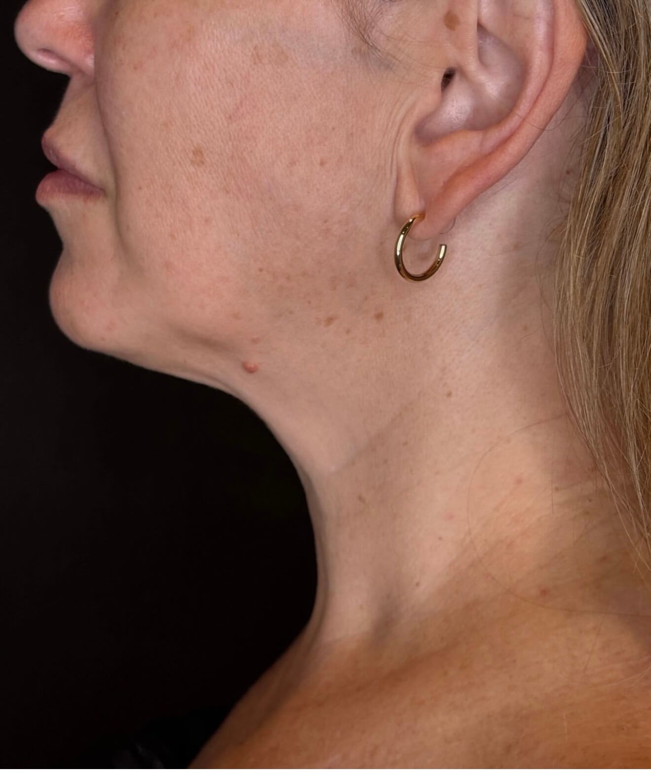 Smooth & Sculpted After