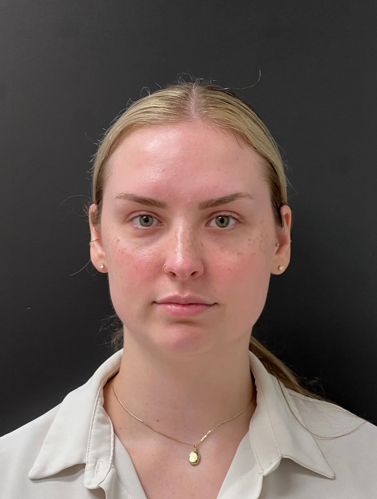 Full Facial Rejuvenation Before