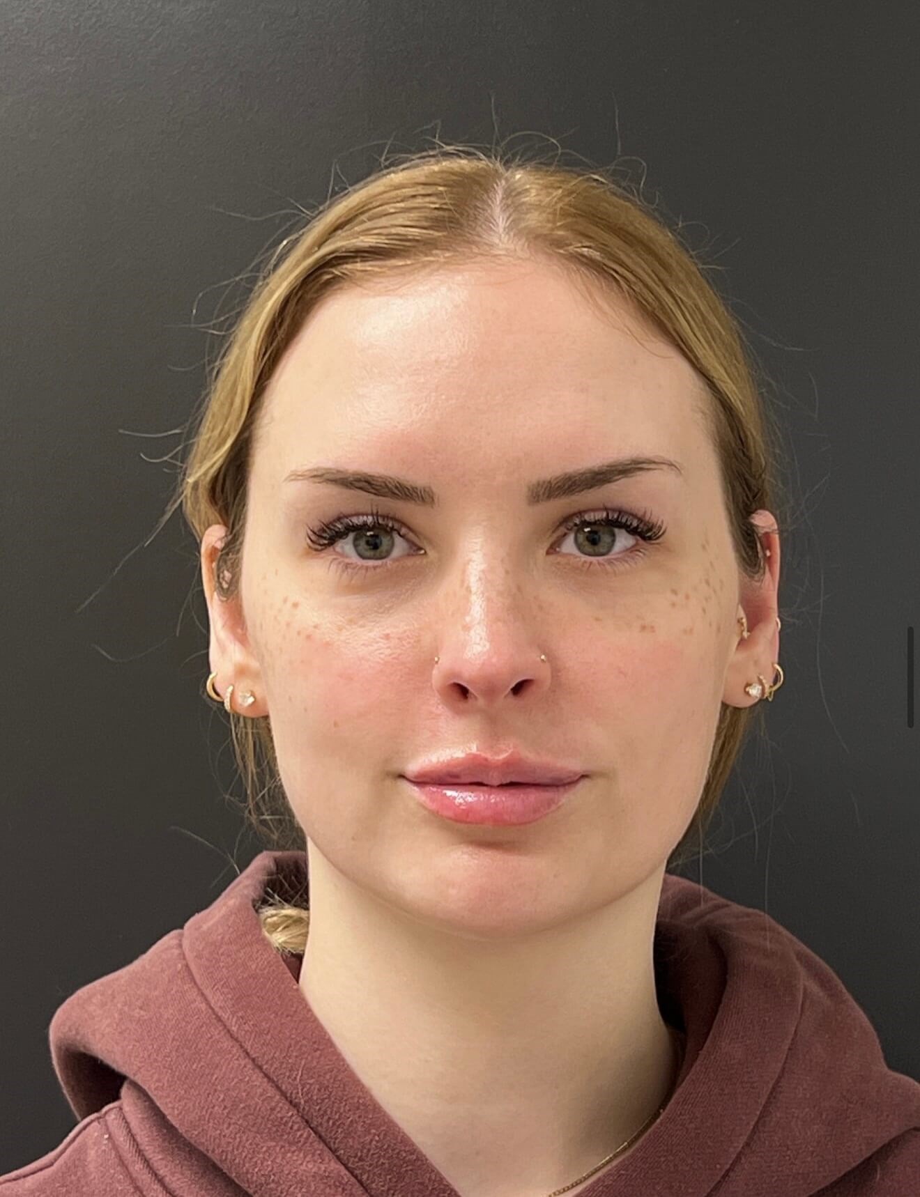Full Facial Rejuvenation After