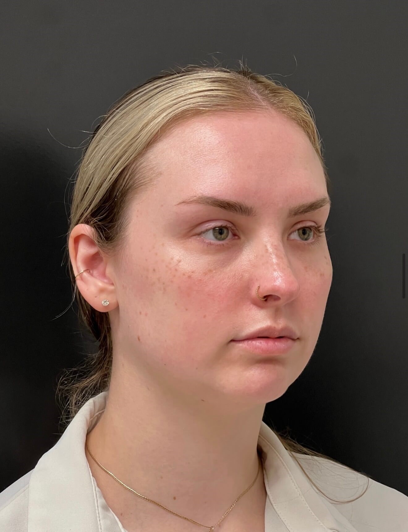Full Facial Rejuvenation Before