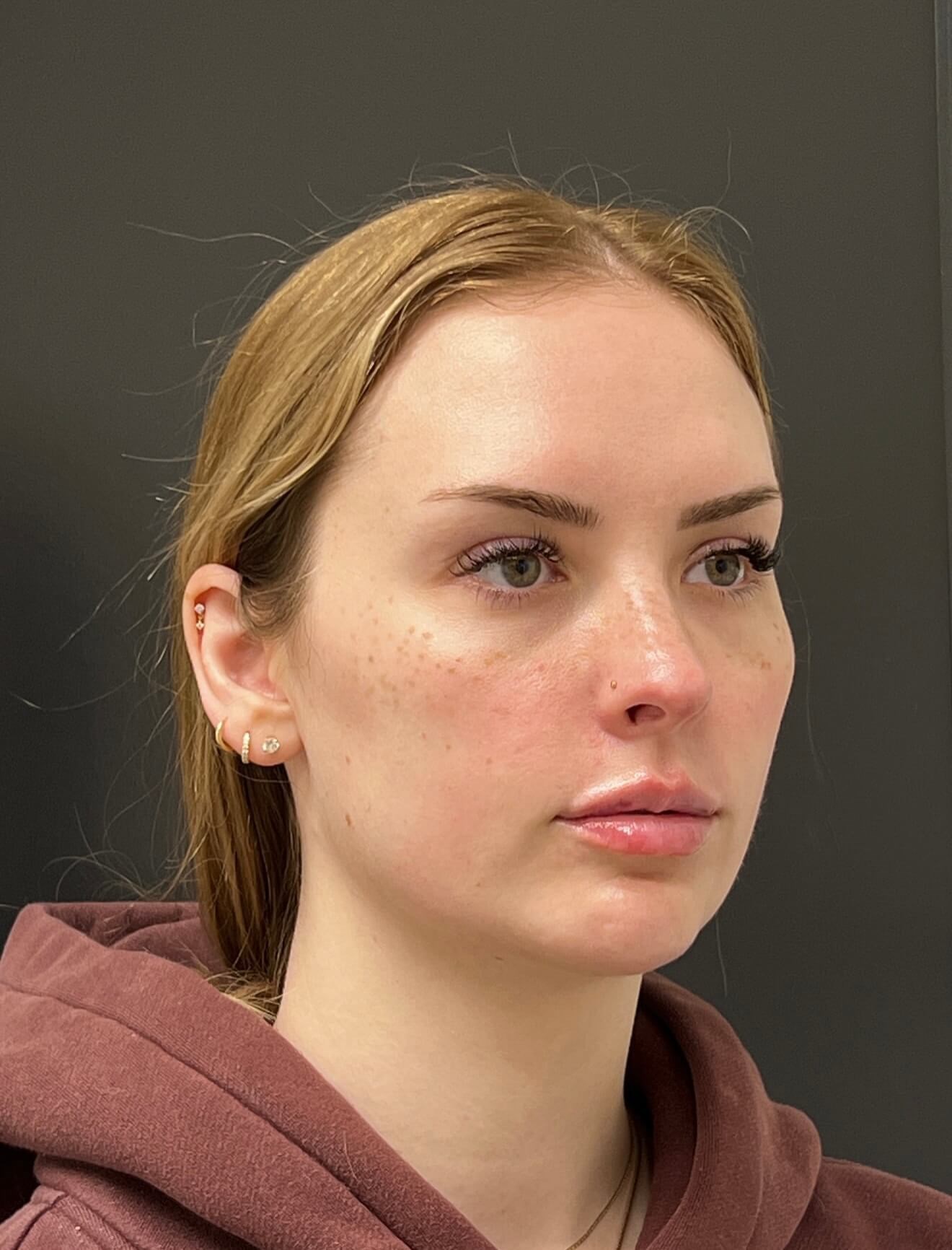 Full Facial Rejuvenation After