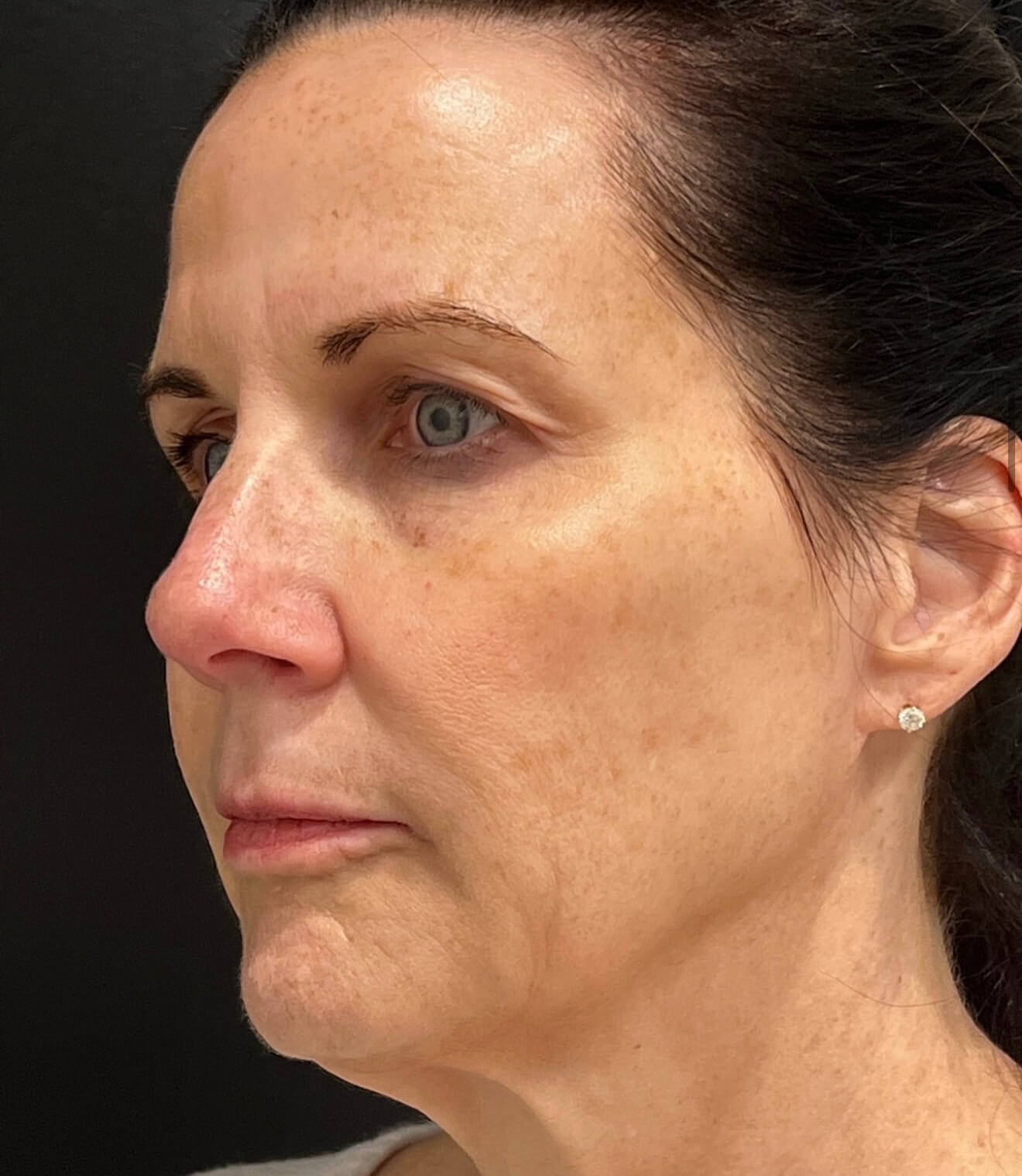 Skin Renewal: Moxi & SylfirmX Before