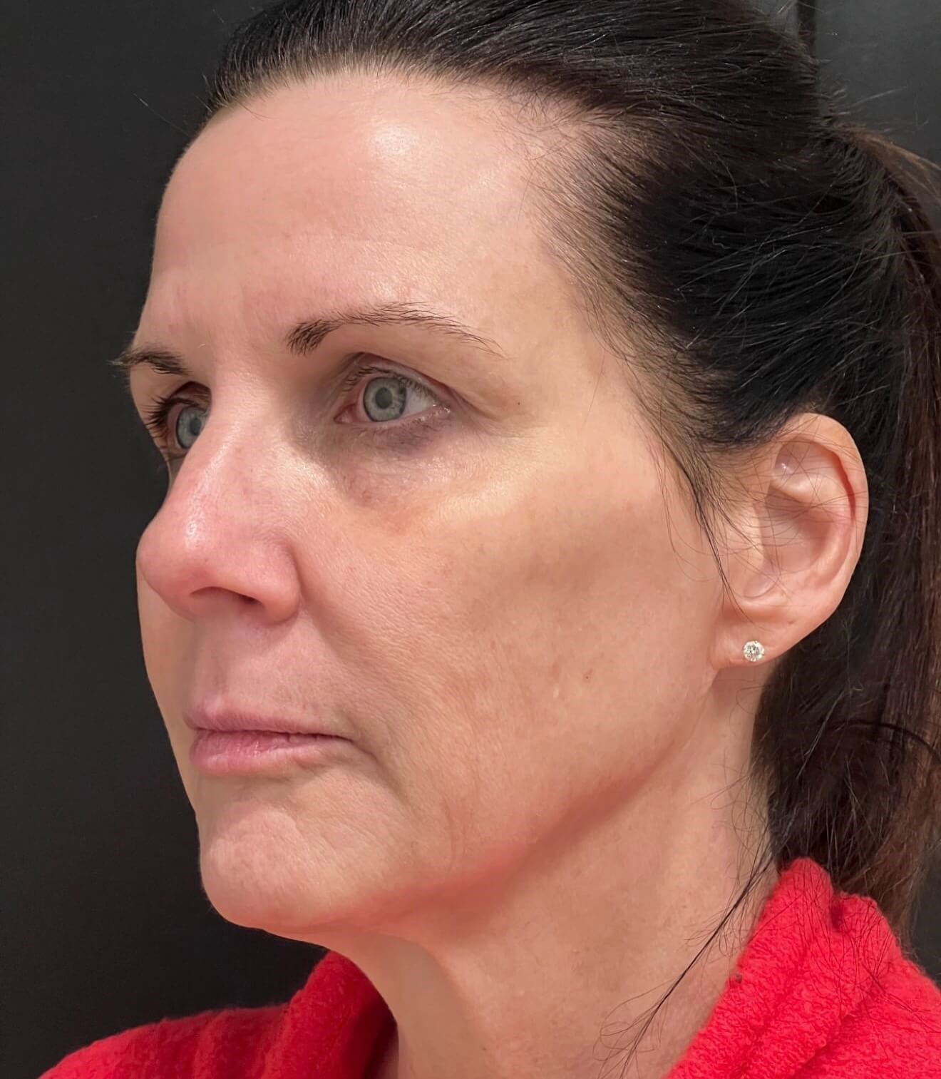 Skin Renewal: Moxi & SylfirmX After