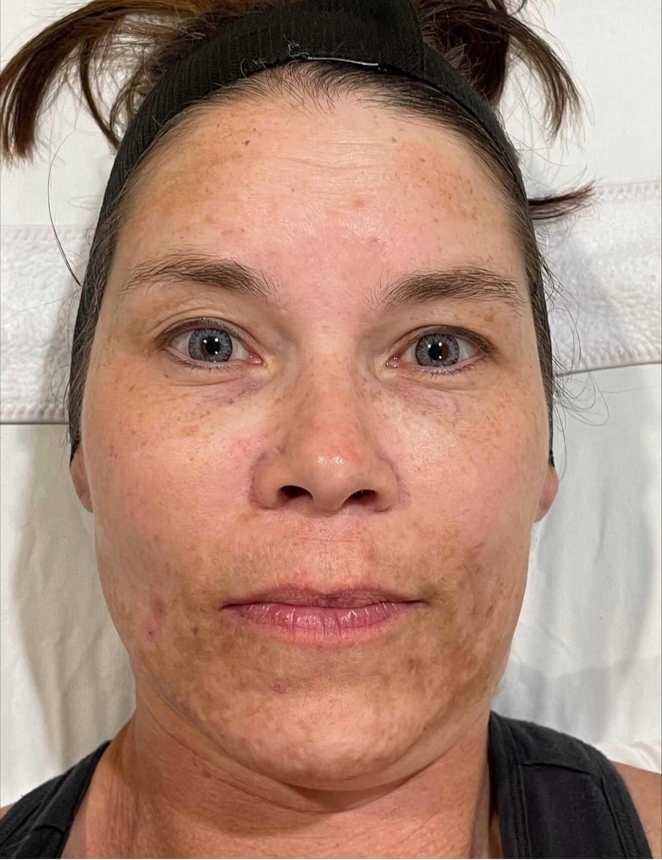 Melanage Ultra Glow Before