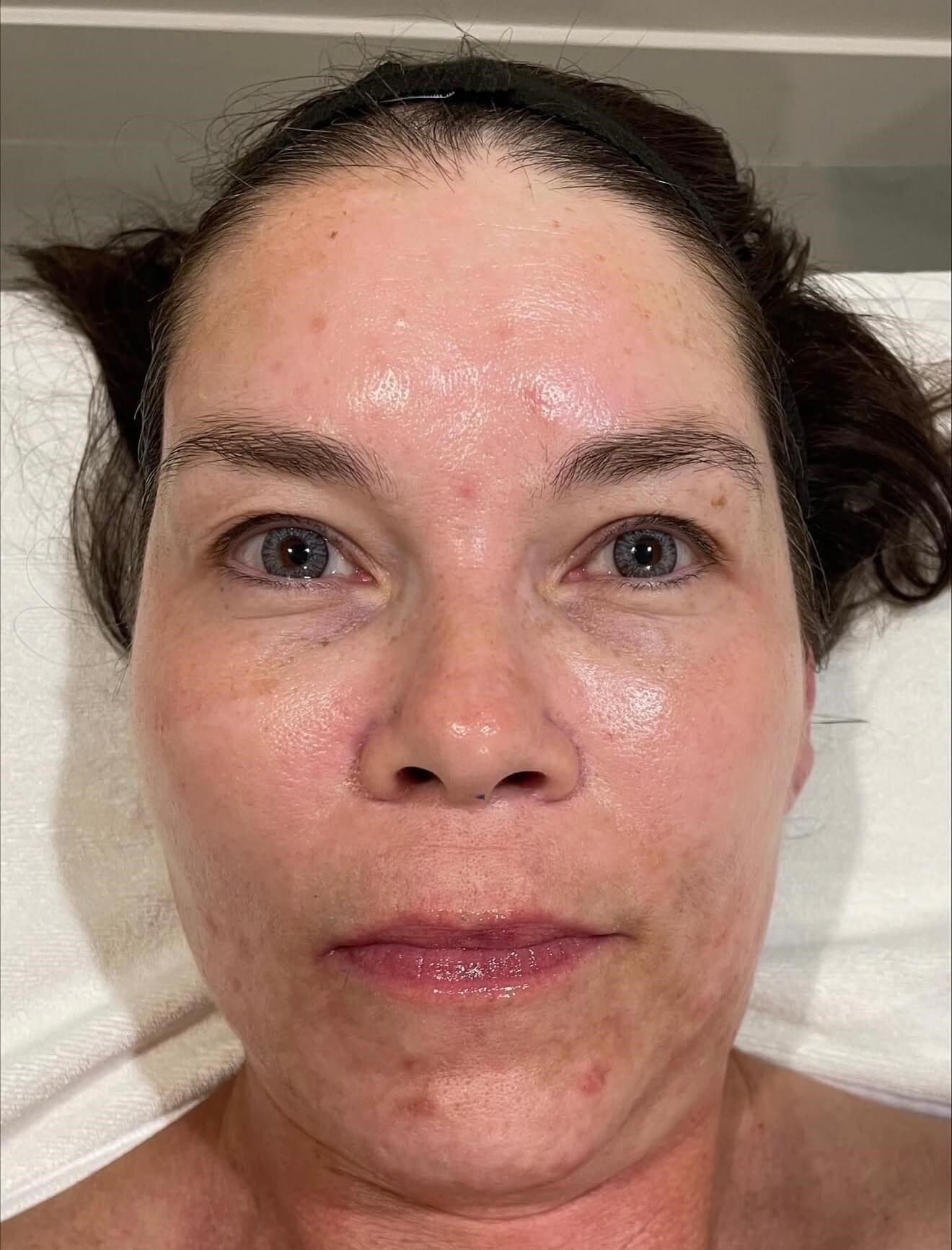 Melanage Ultra Glow After