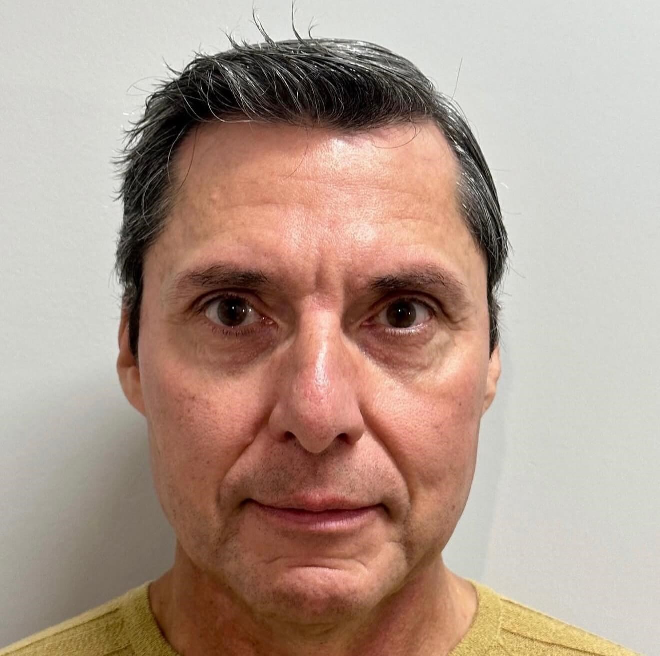 Sculptra Rejuvenation Before
