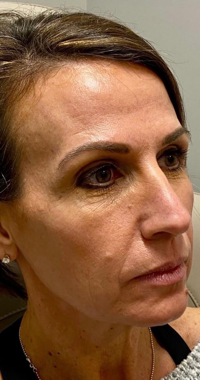 Collagen Restored Before