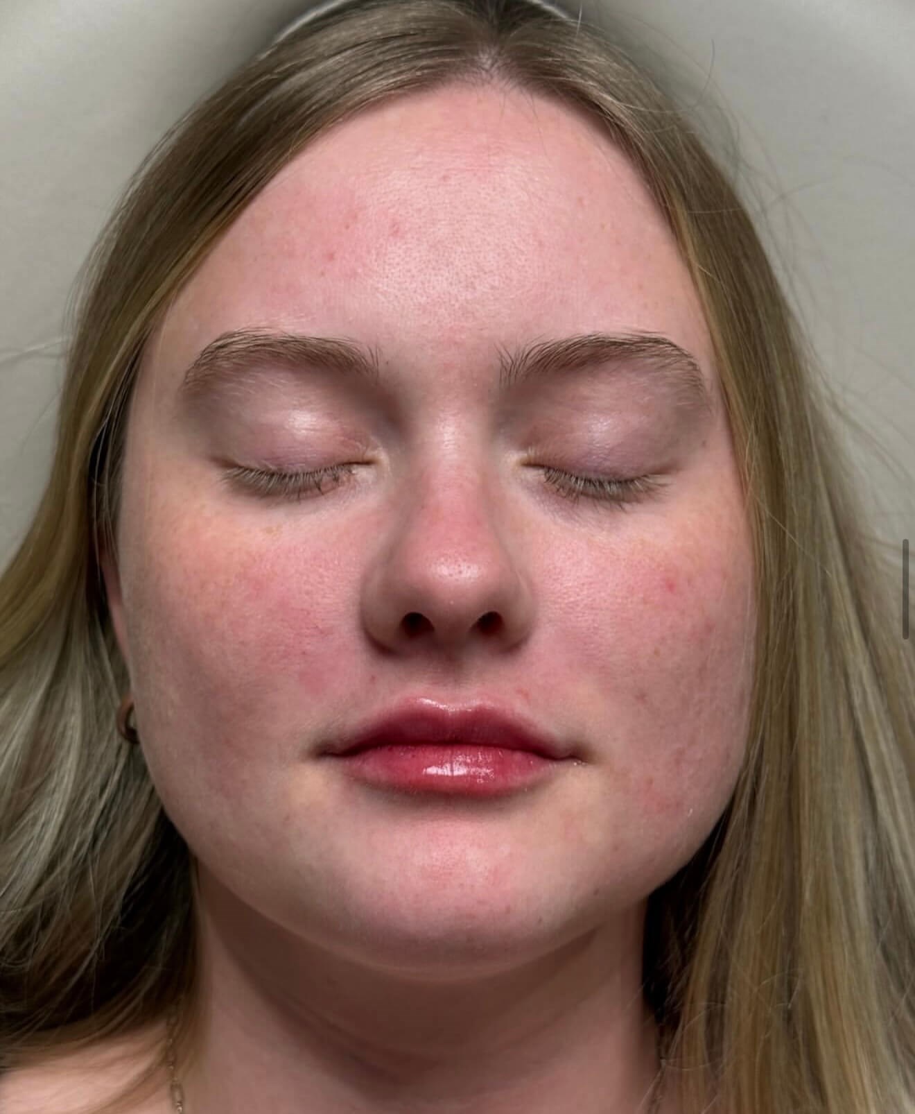 Restylane Refresh After