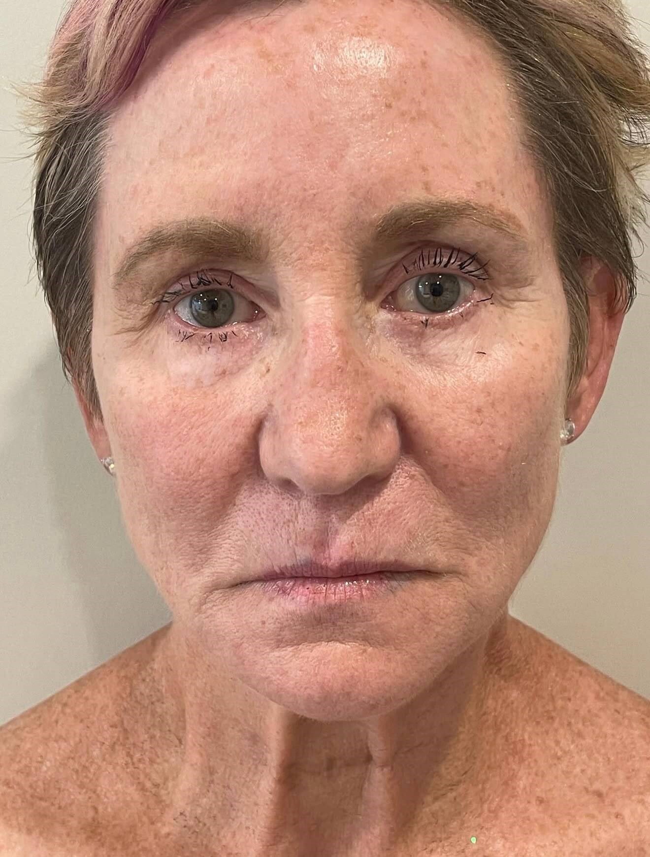 Radiant Skin with Halo Before