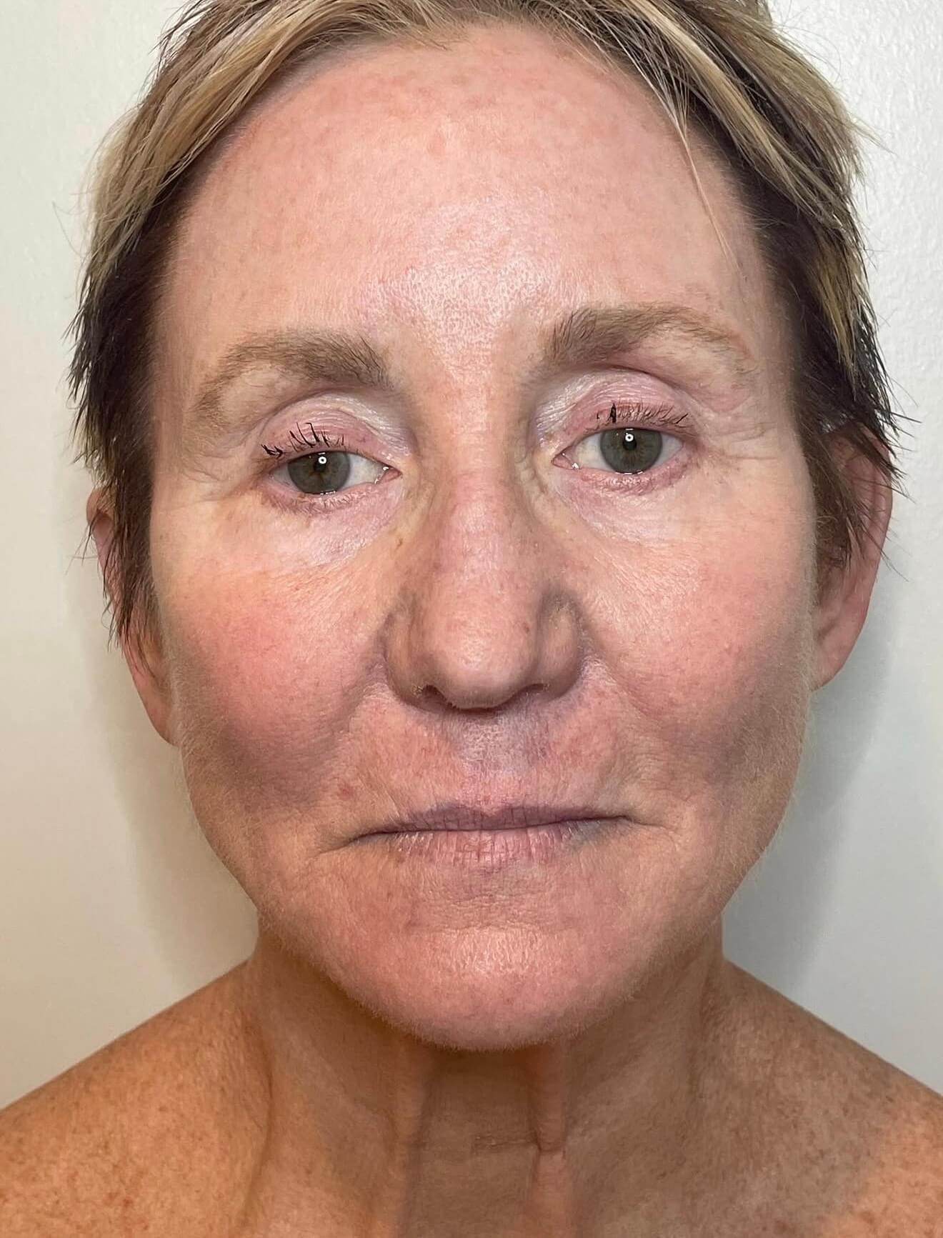 Radiant Skin with Halo After