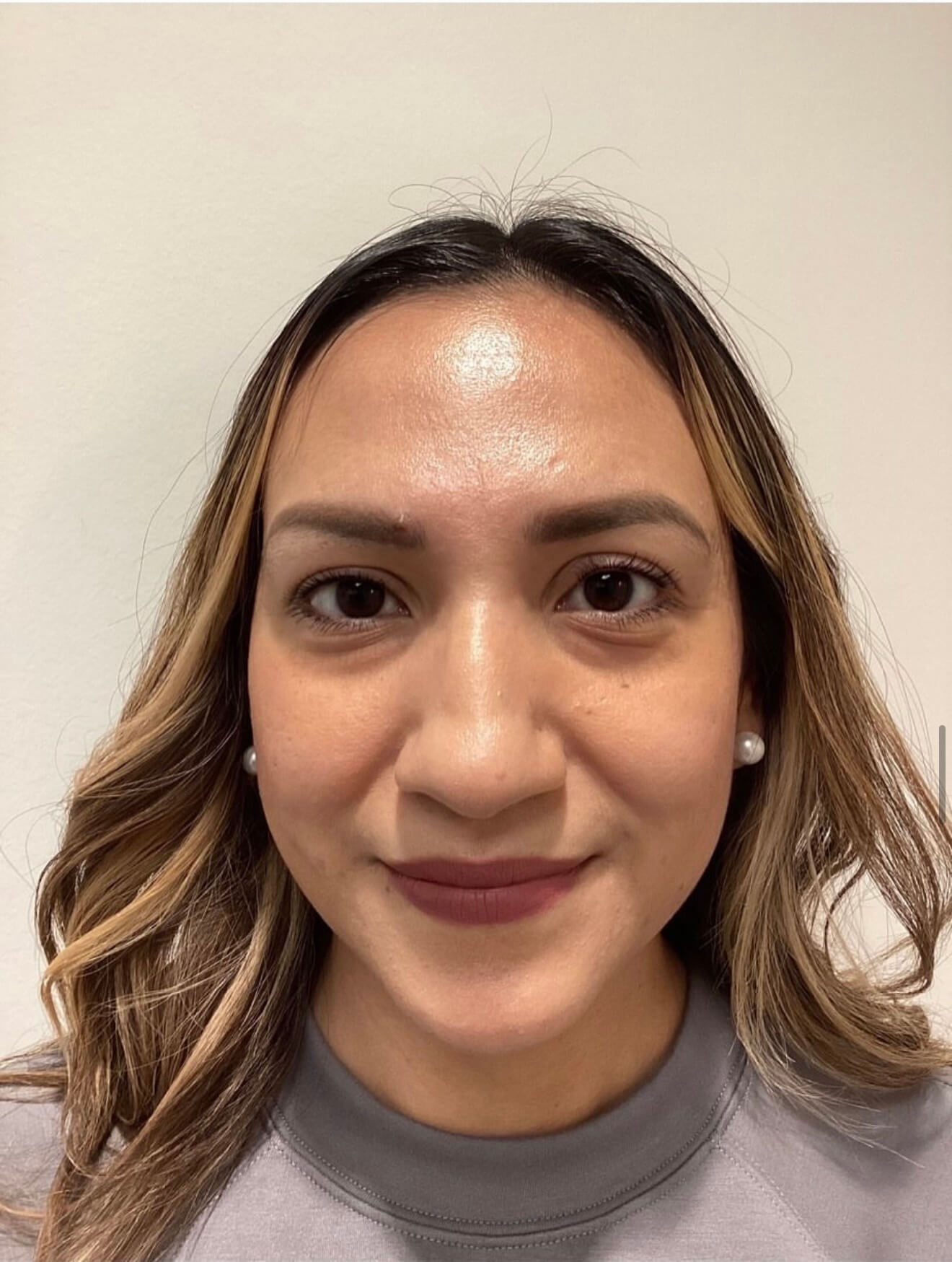 Facial Rejuvenation Results Before