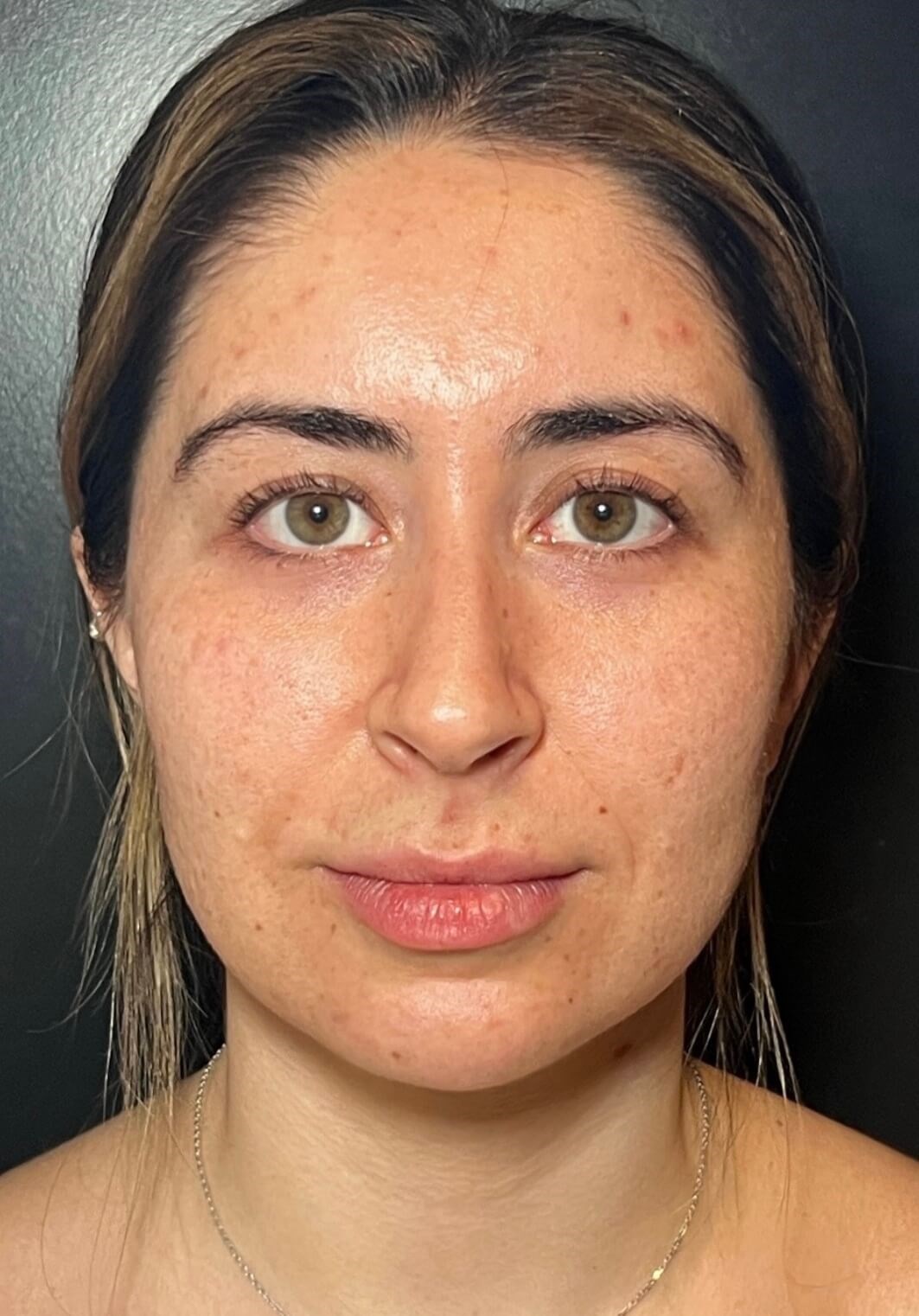 DiamondGlow Skin Renewal Before