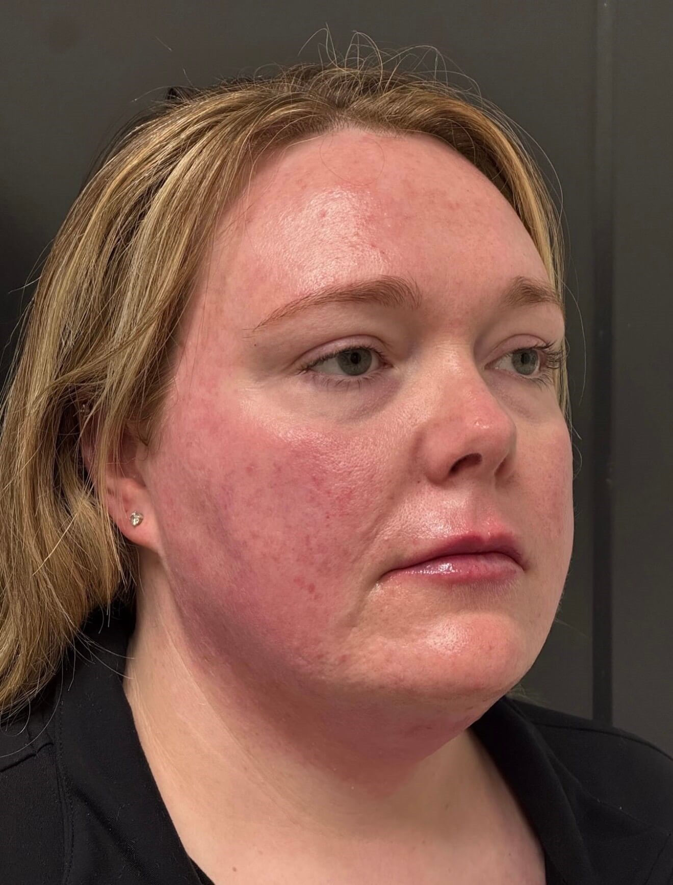 Skinvive: Redness Relief Before