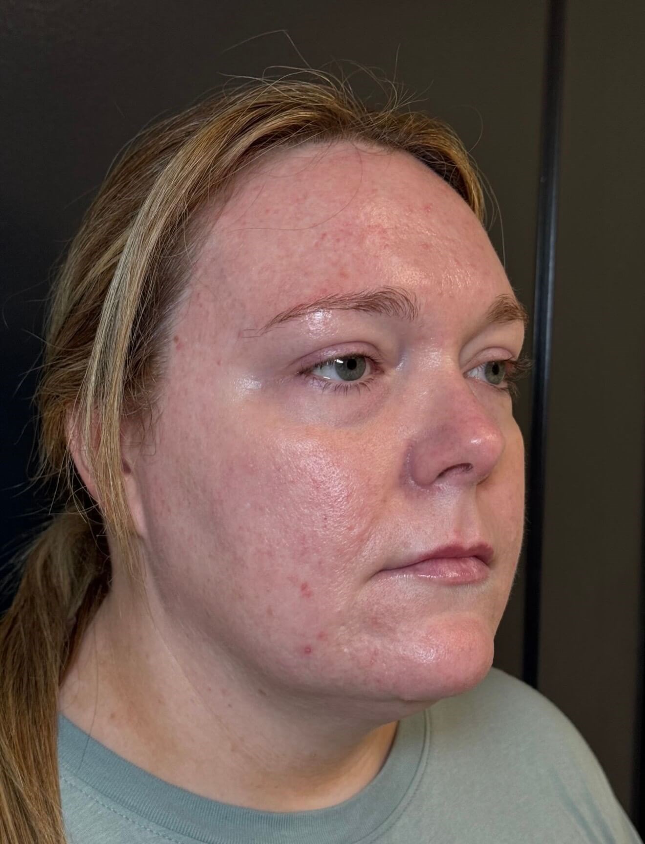 Skinvive: Redness Relief After