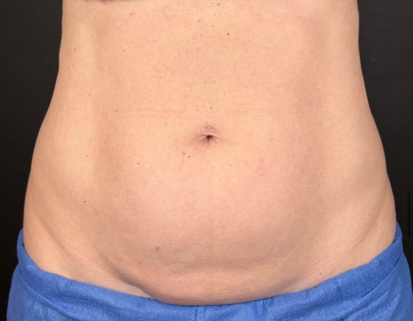 Contoured with Coolsculpting Before