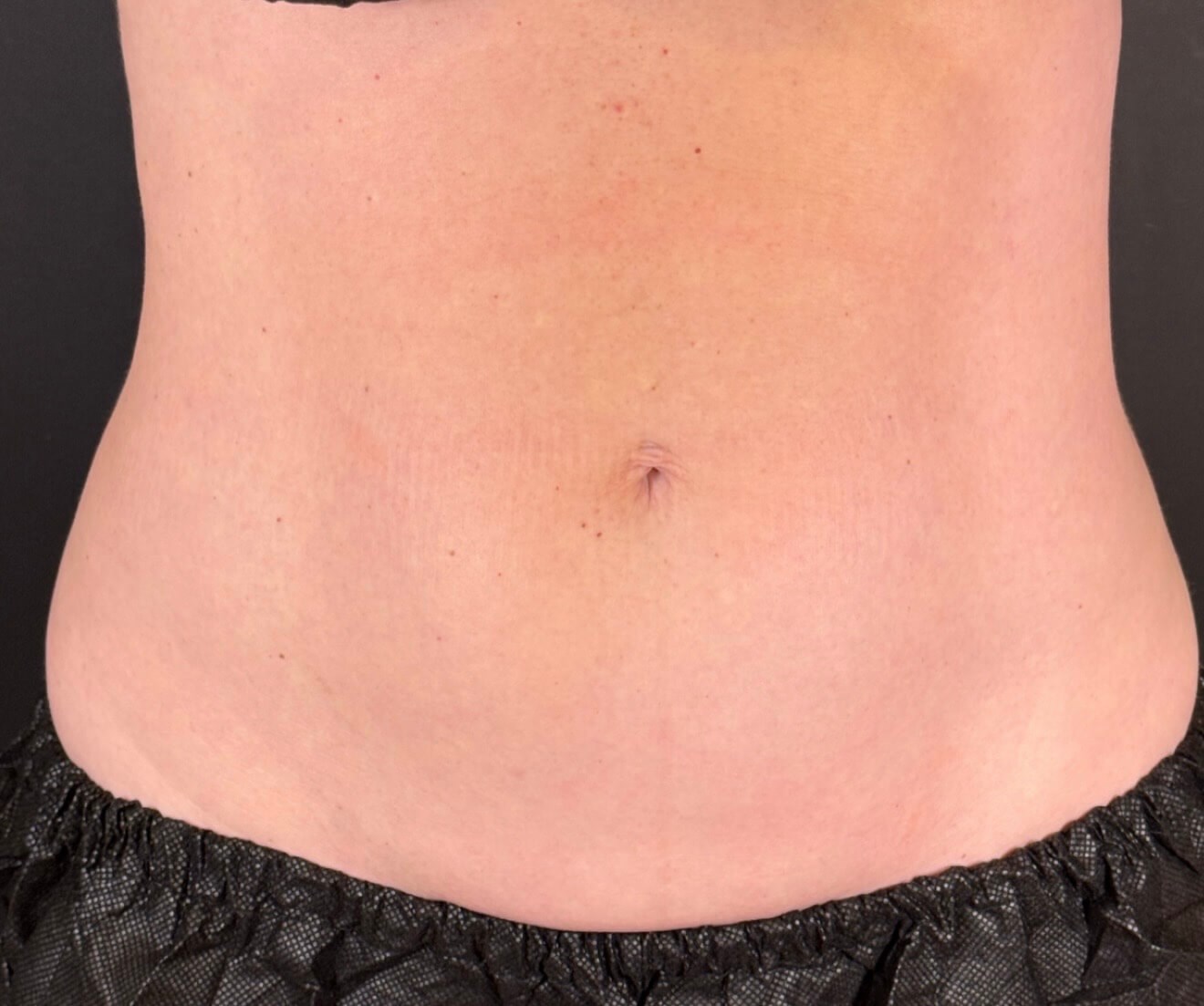 Contoured with Coolsculpting After