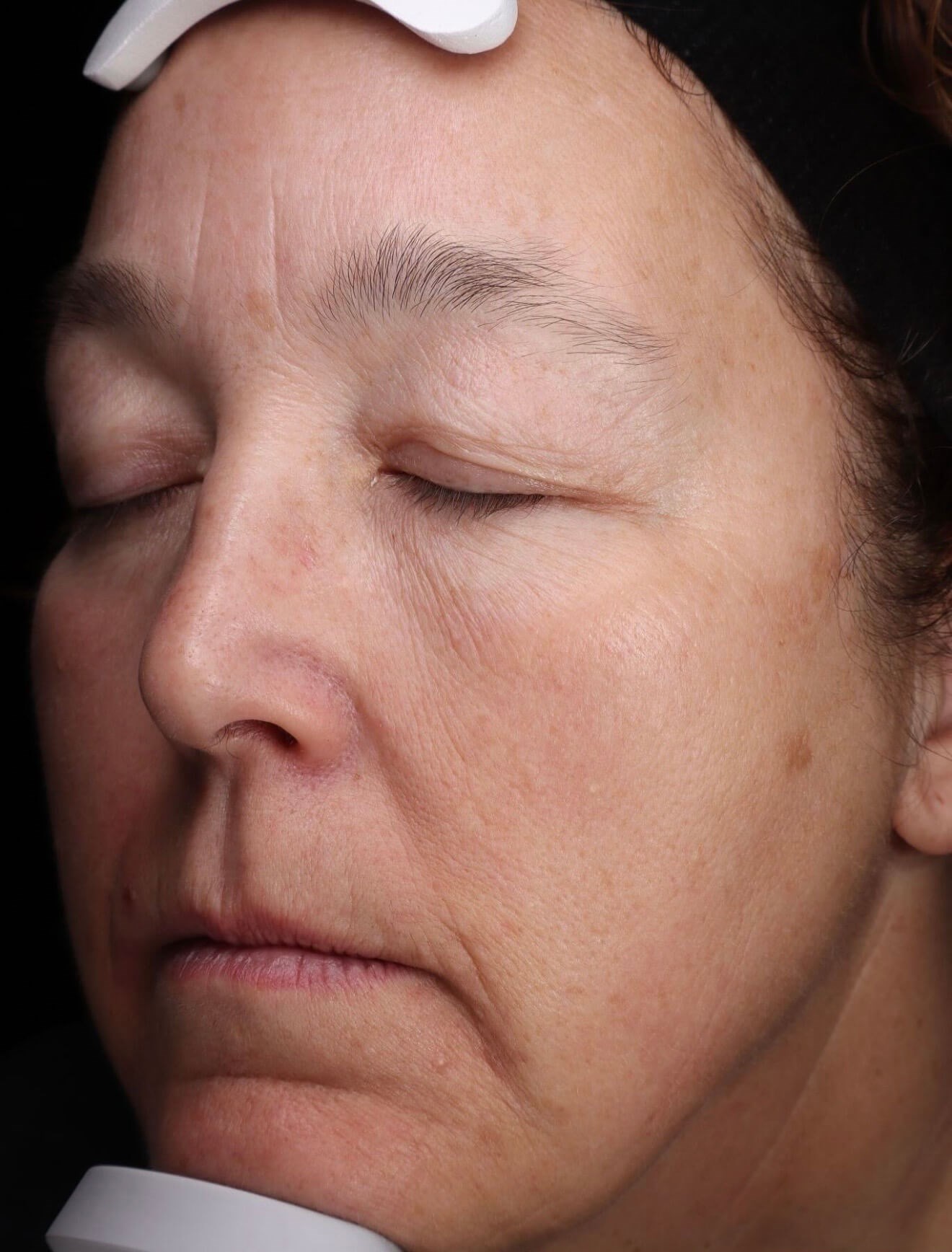 BBL Skin Renewal After