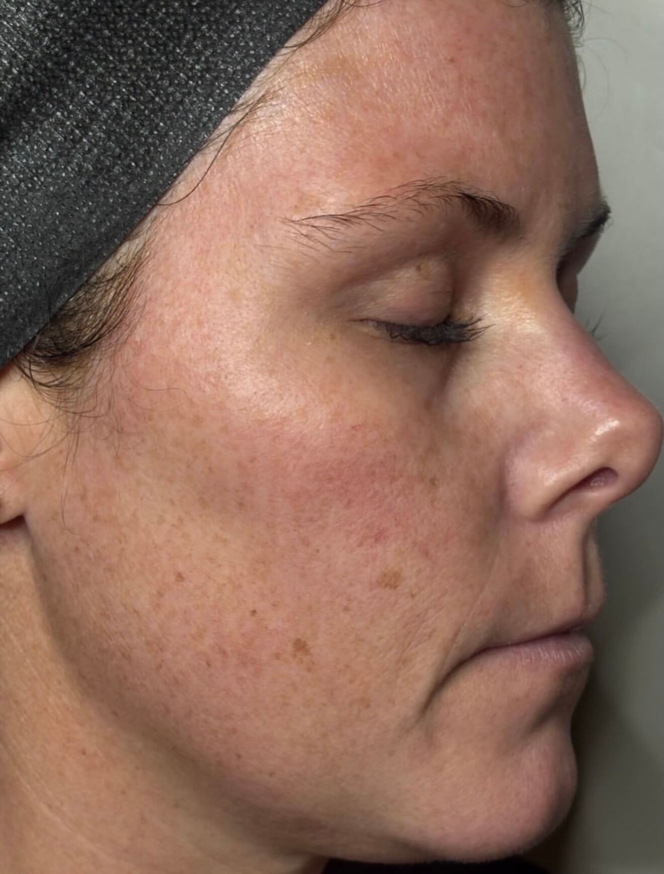 MOXI Elite Transformation Before