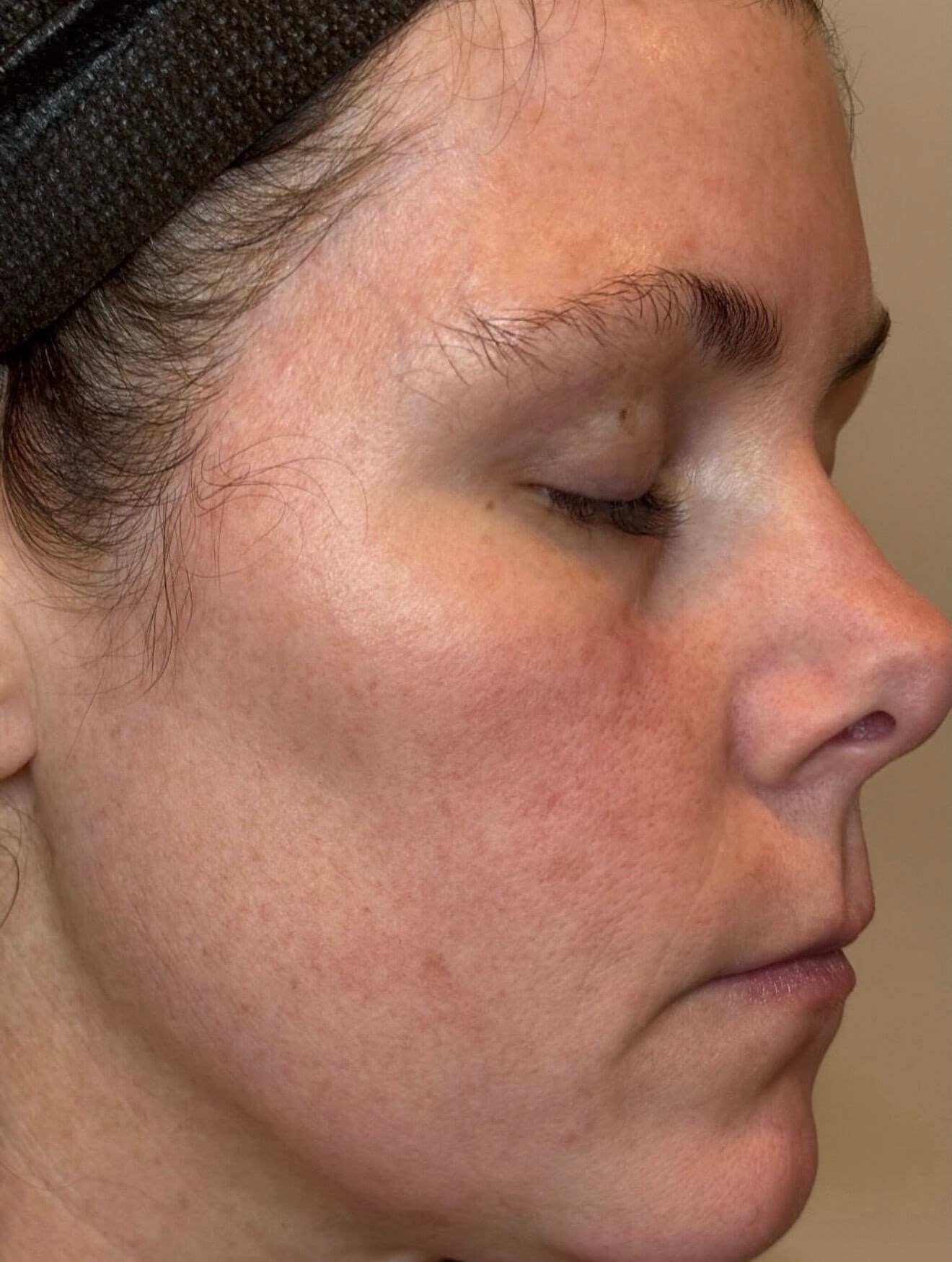 MOXI Elite Transformation After
