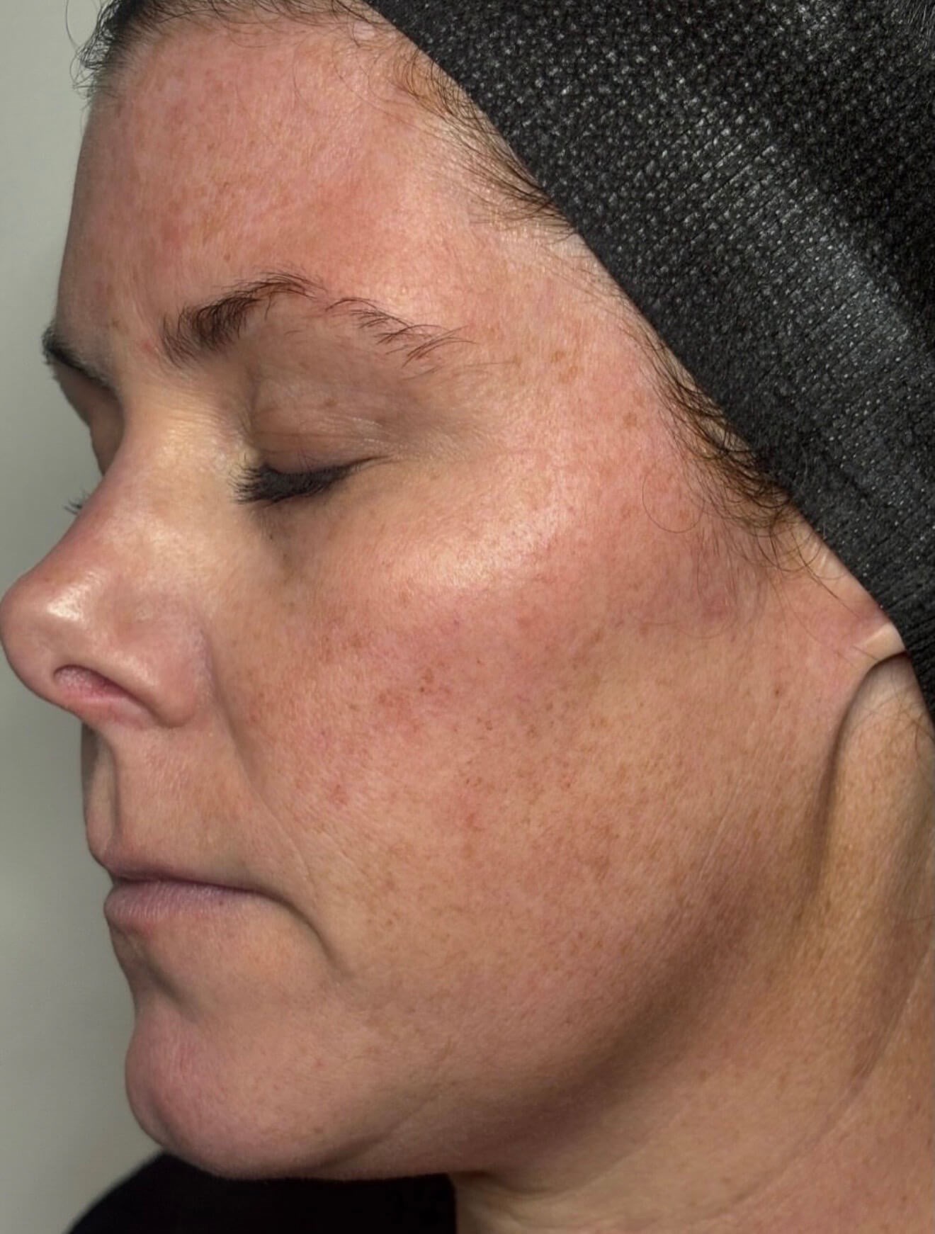 MOXI Elite Transformation Before