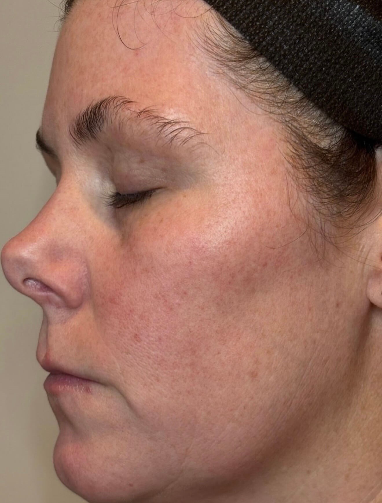 MOXI Elite Transformation After