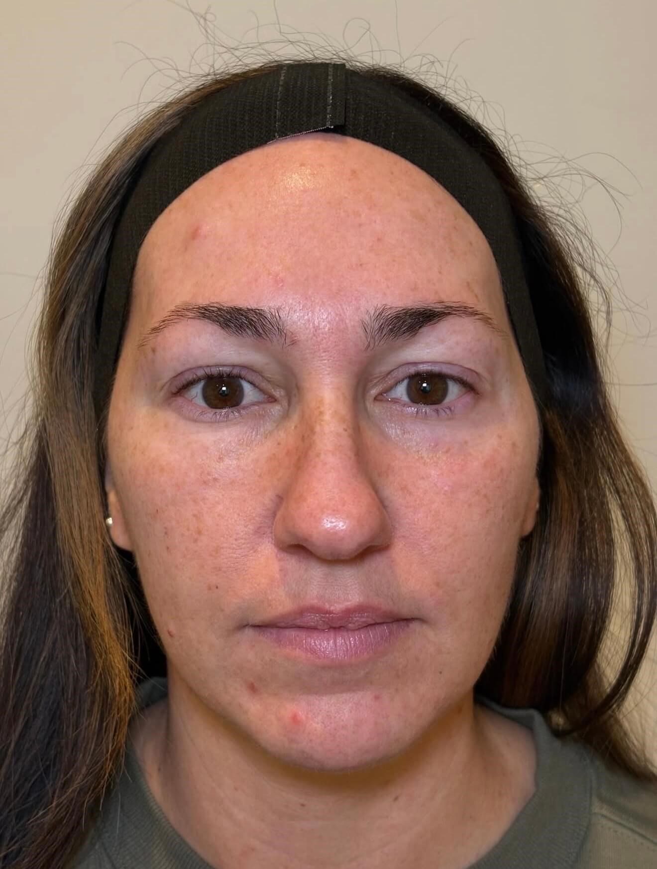 BBL Skin Renewal Before