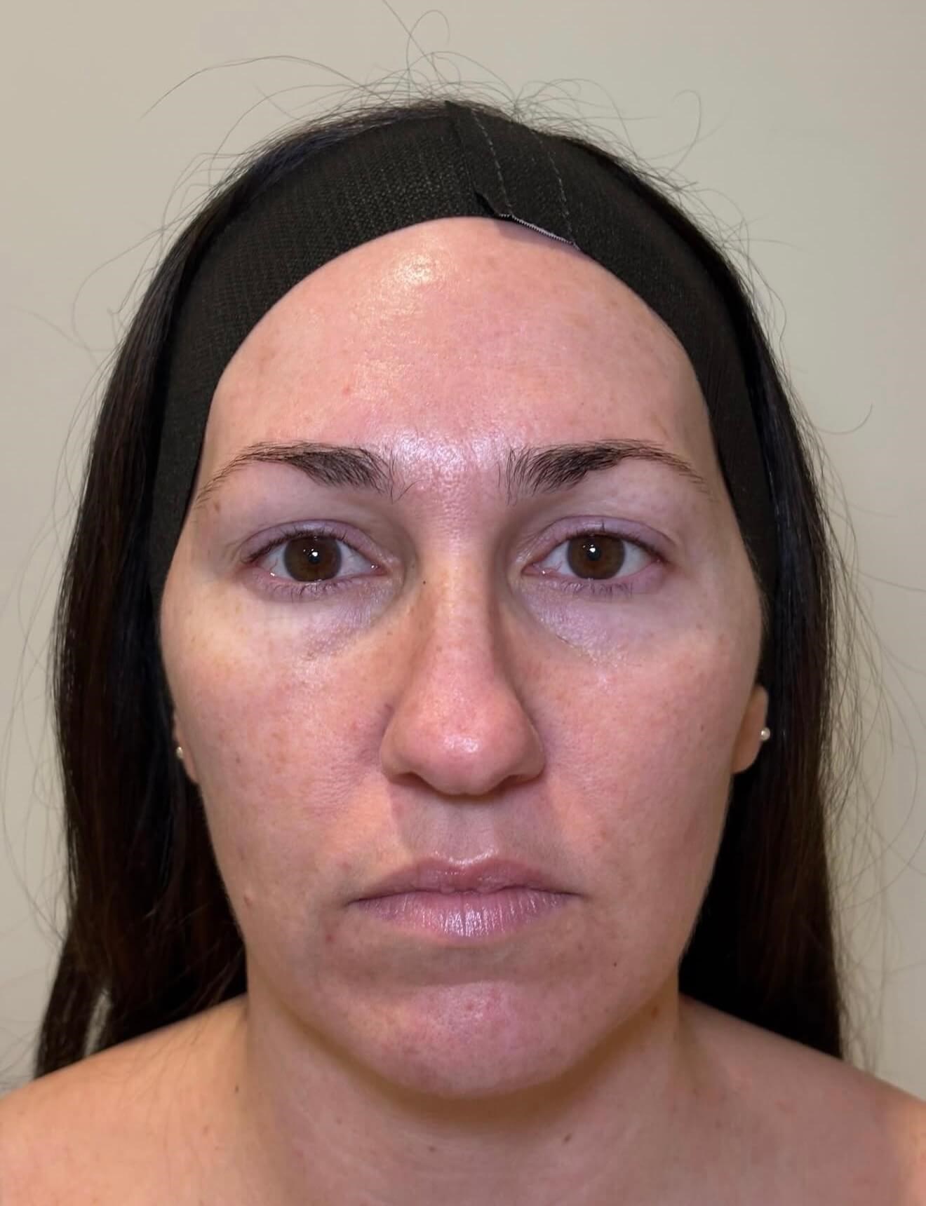 BBL Skin Renewal After