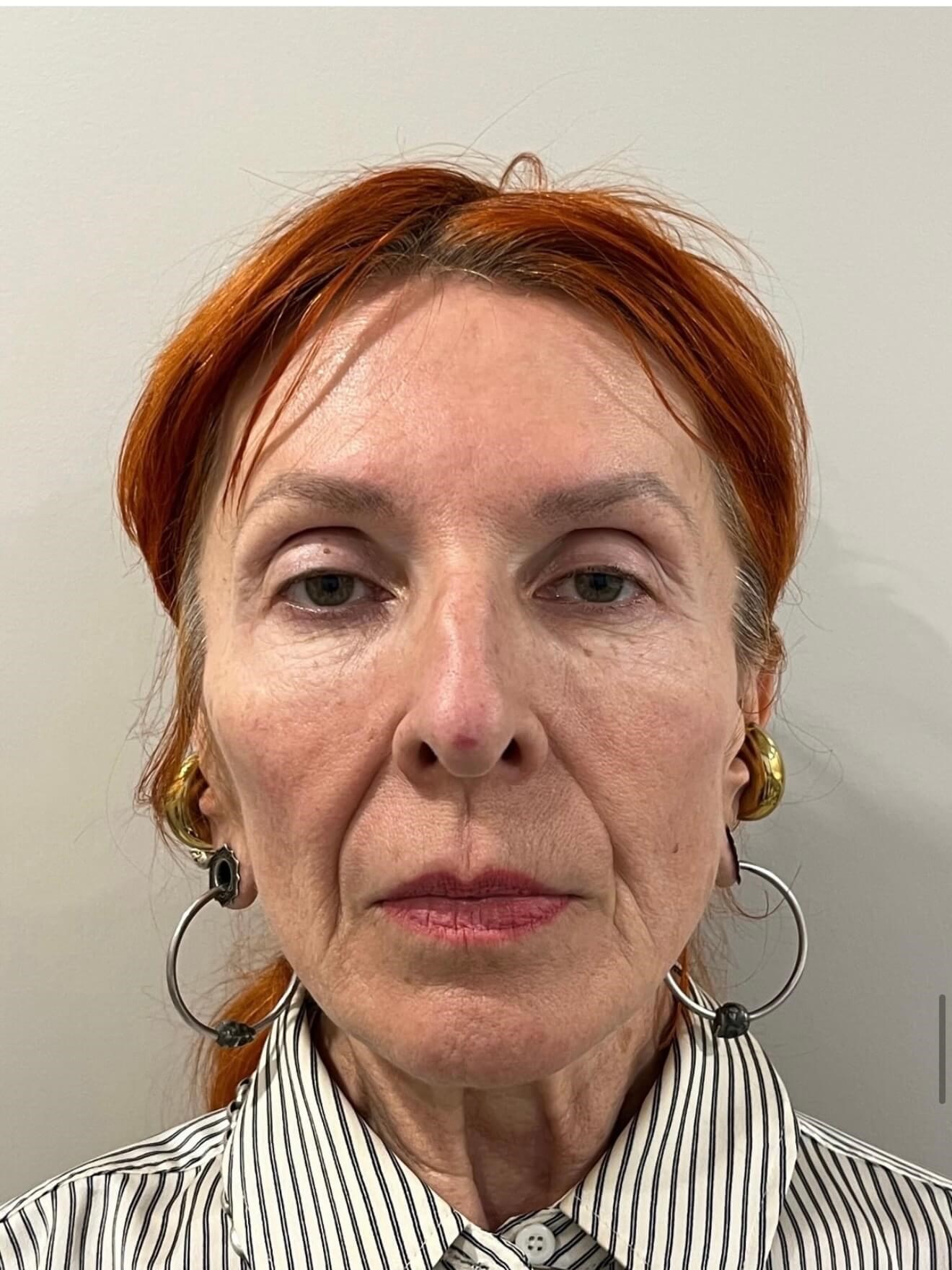 Full Face Renewal Before