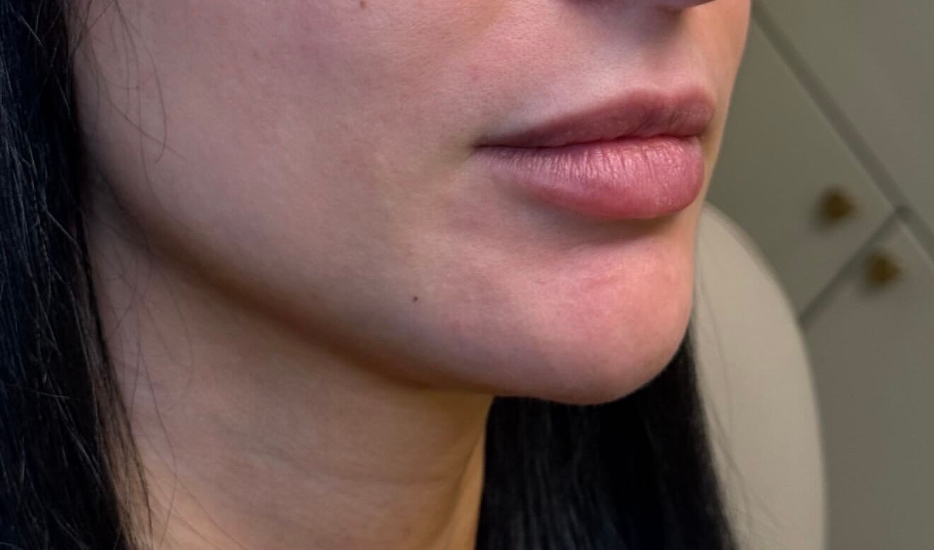 Defined & Hydrated Lips Before
