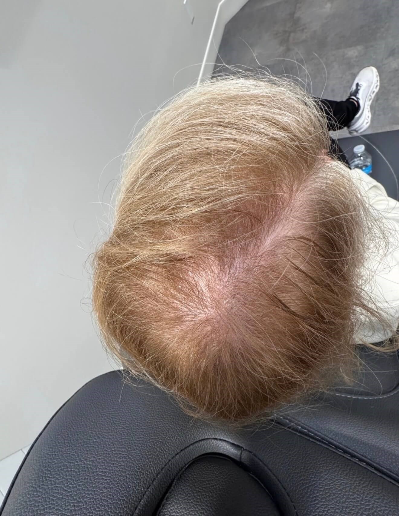 Revitalized Hair Growth Before
