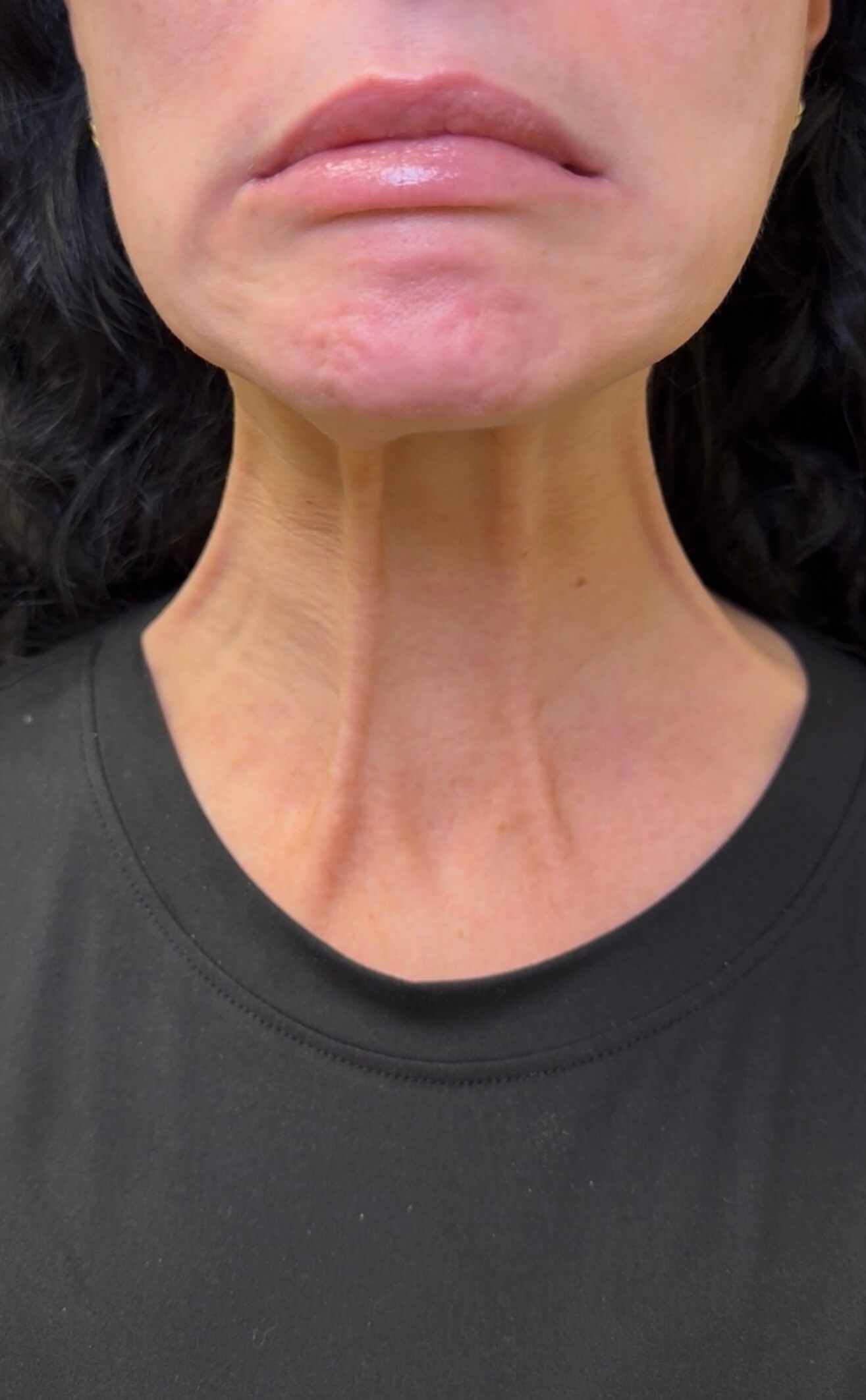 Lower Face Rejuvenation Before