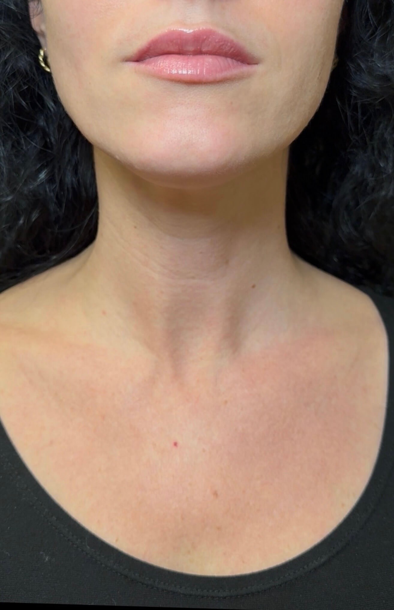 Lower Face Rejuvenation After