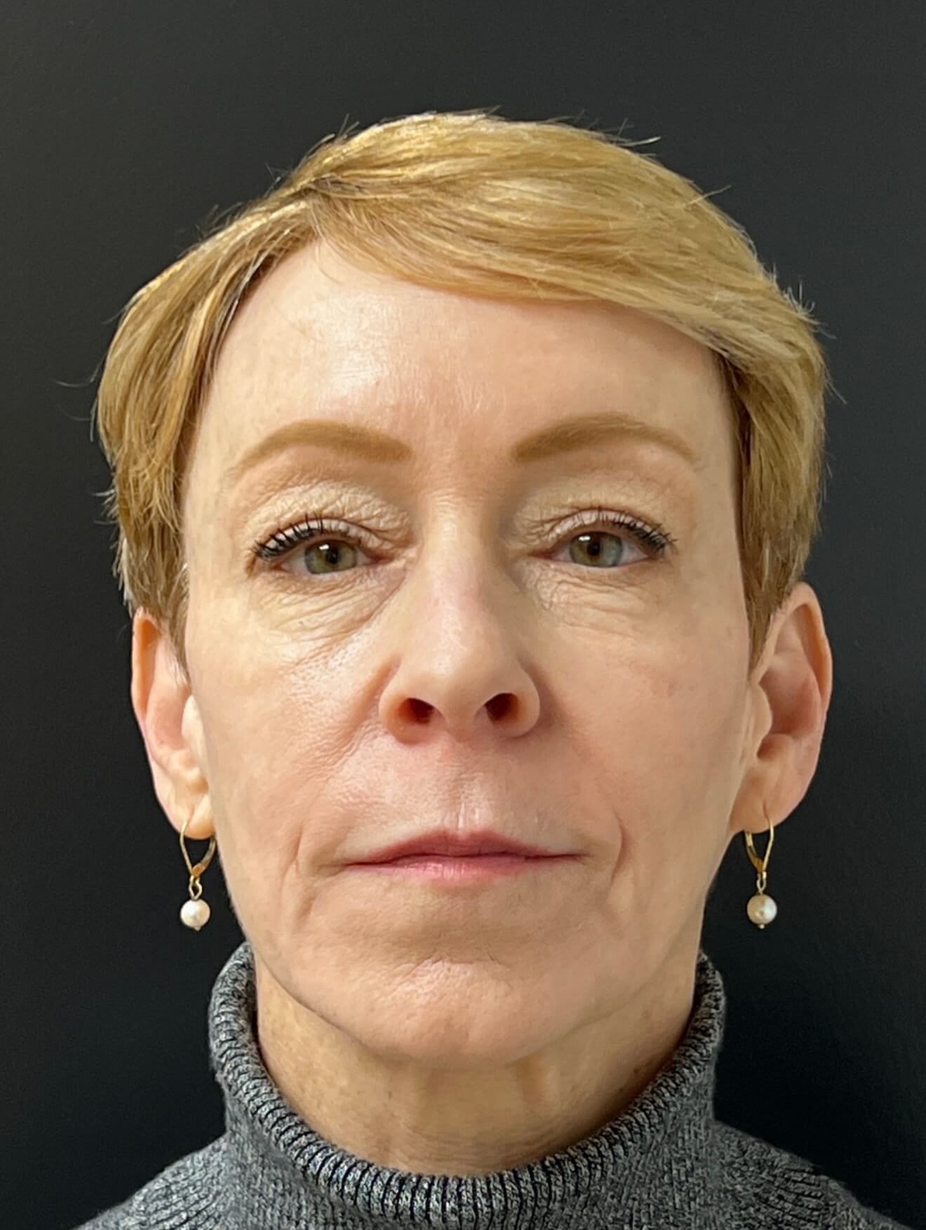 Full Face Refinement After