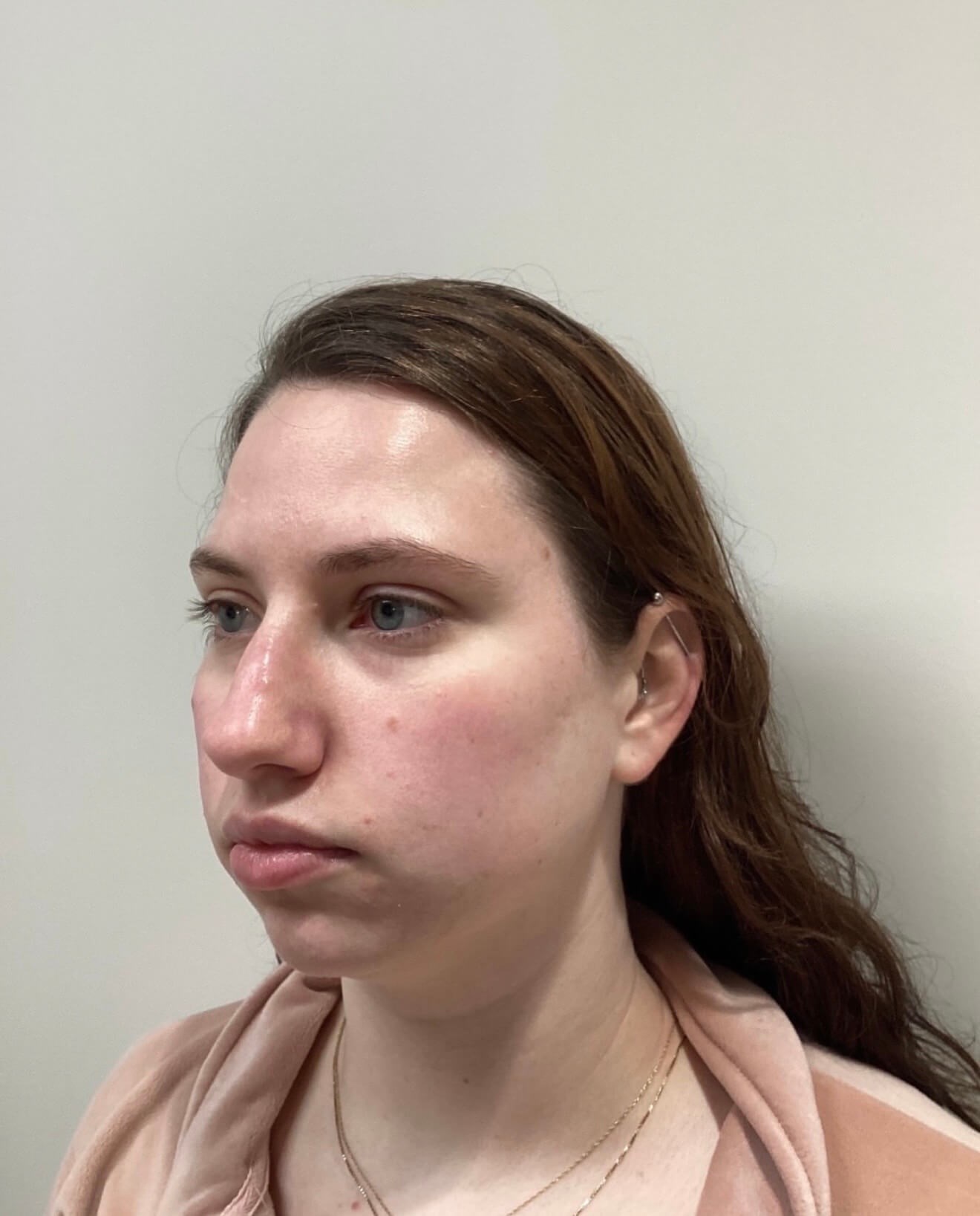 Natural Facial Harmony Before
