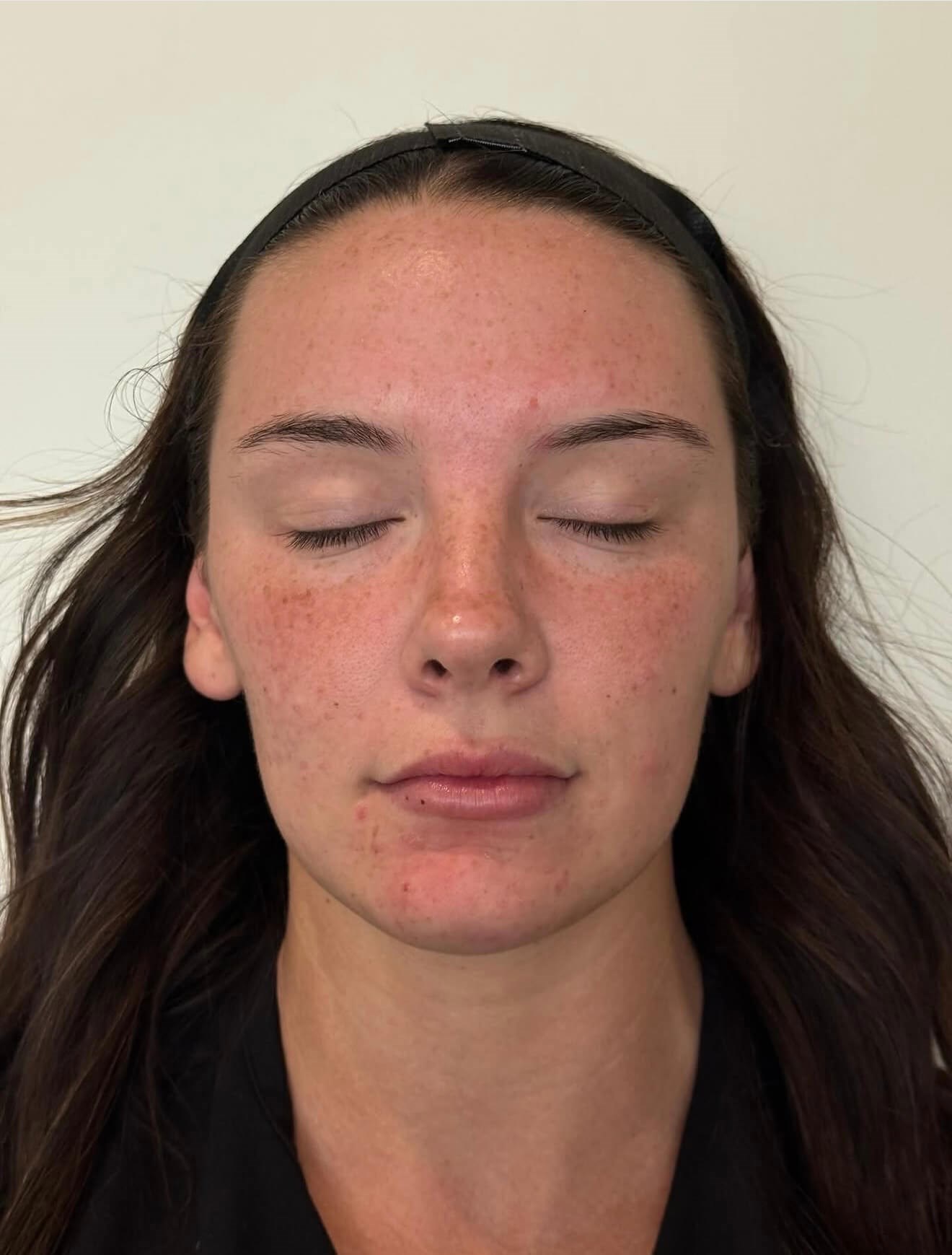 Brighter Skin Results Before