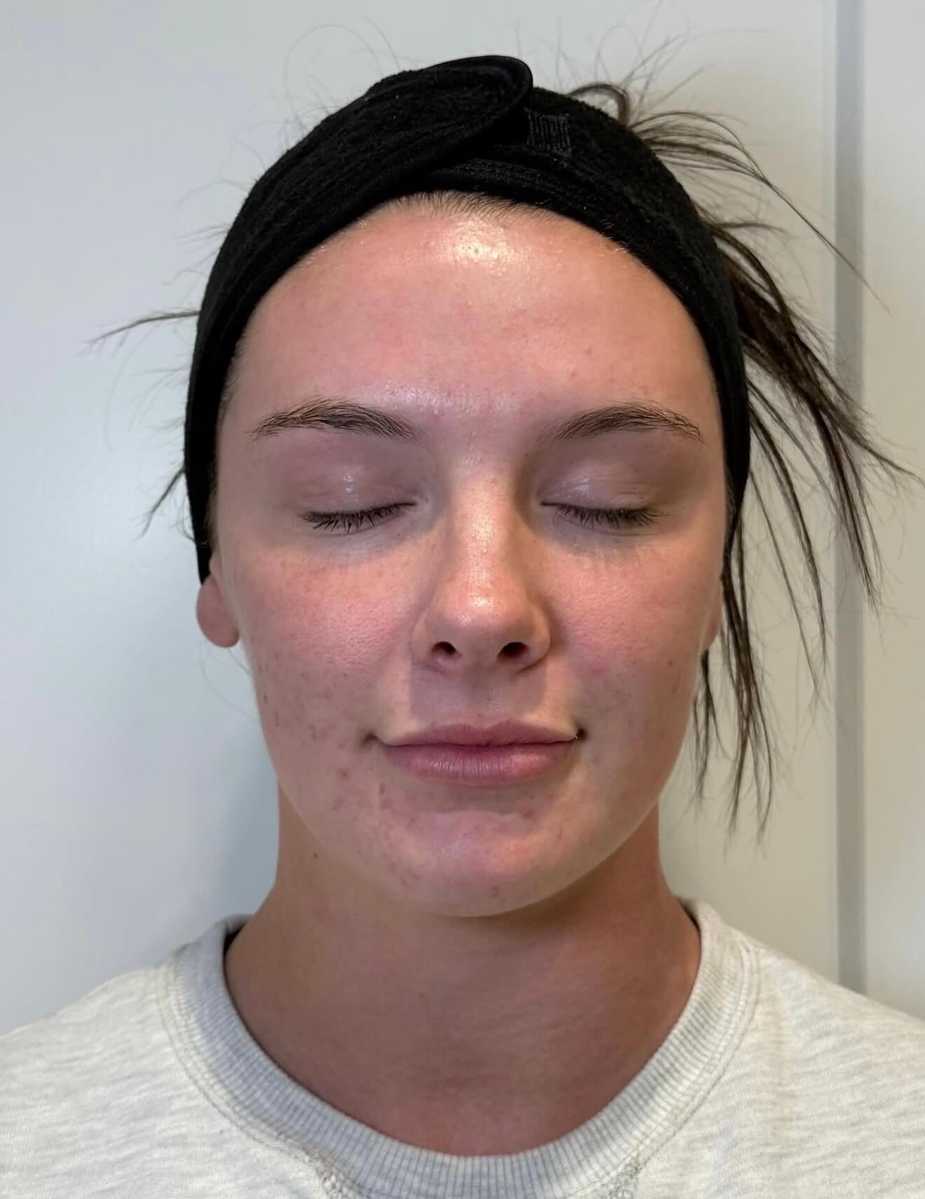 Brighter Skin Results After