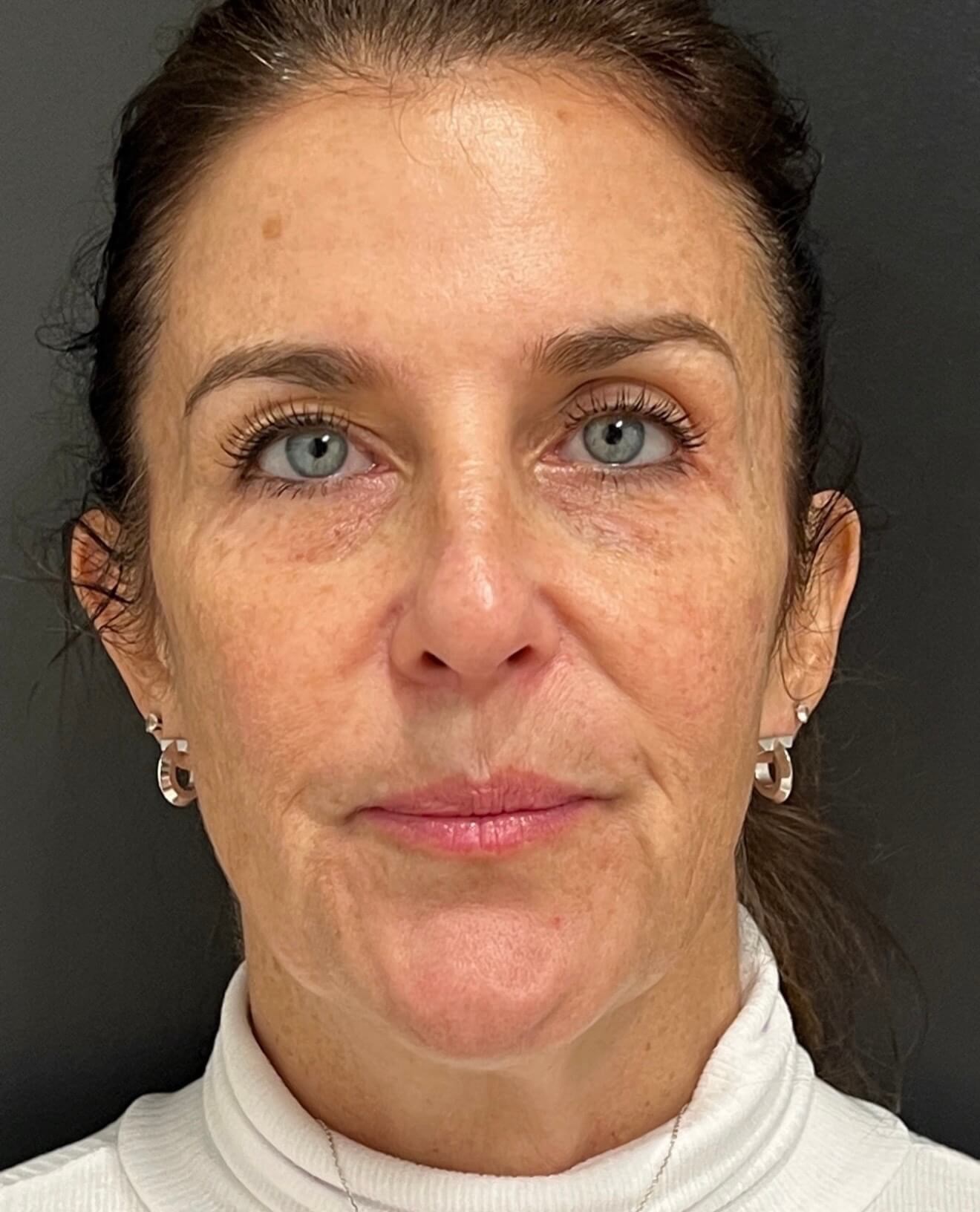 Fresh Face Renewal Before