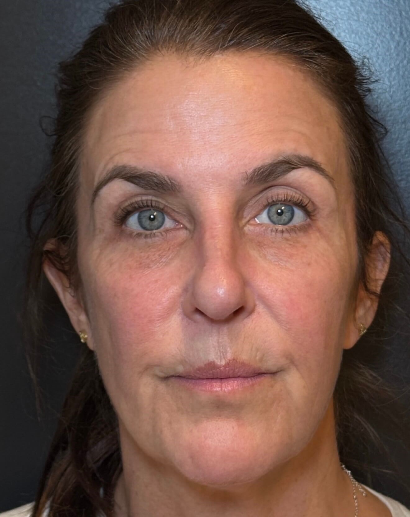 Fresh Face Renewal After