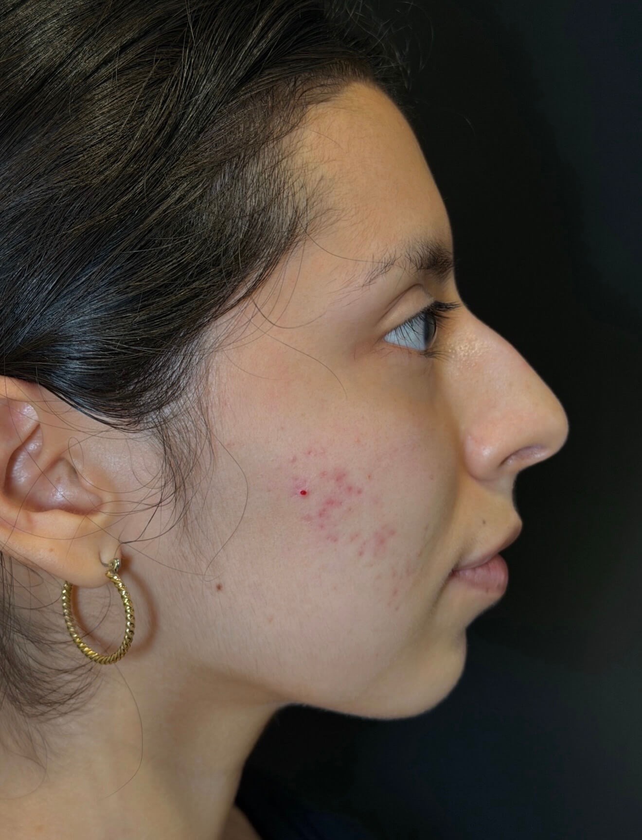 Microneedling Skin Revival Before