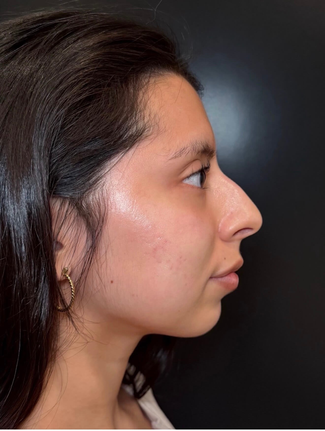 Microneedling Skin Revival After