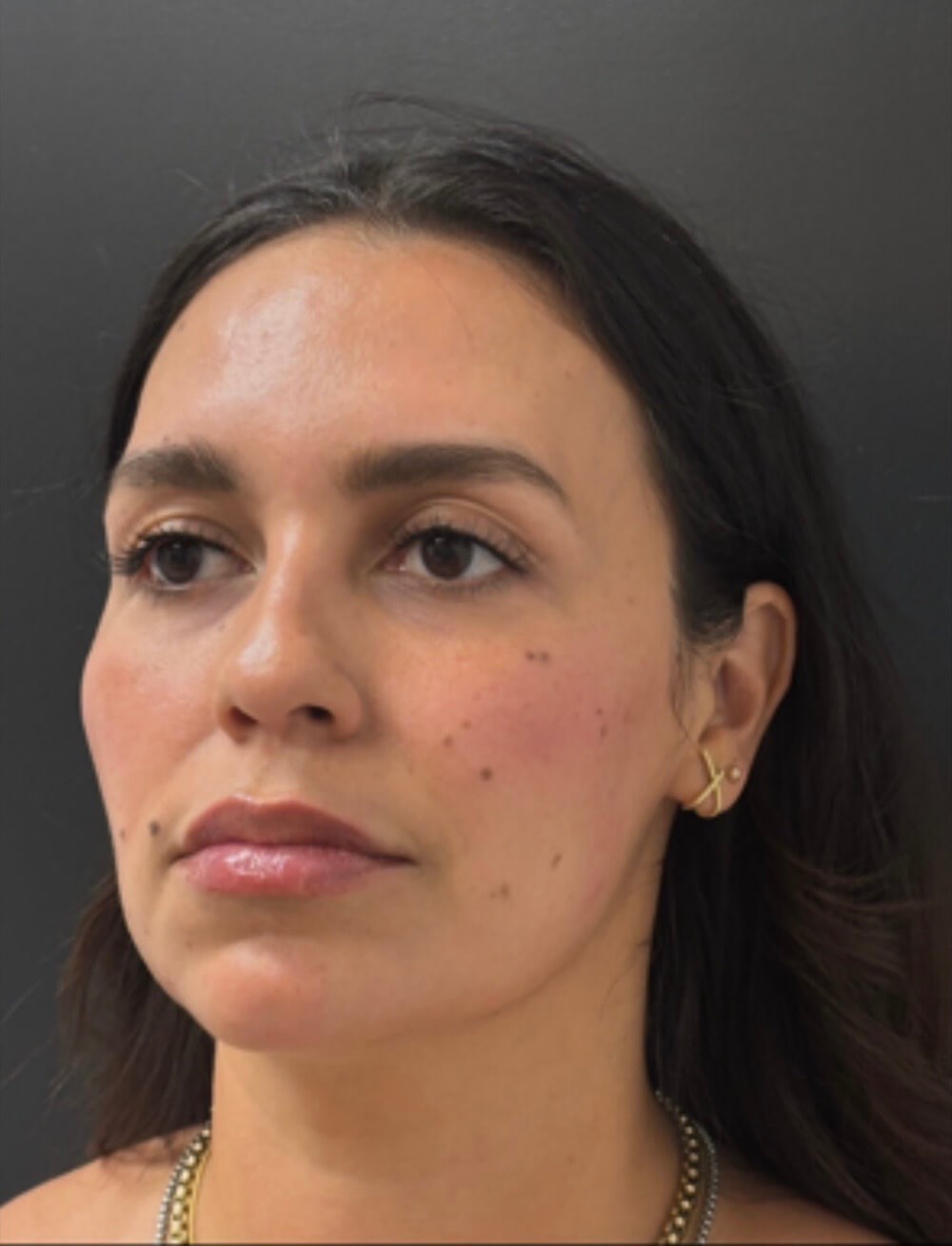 Facial Sculpt & Balance After