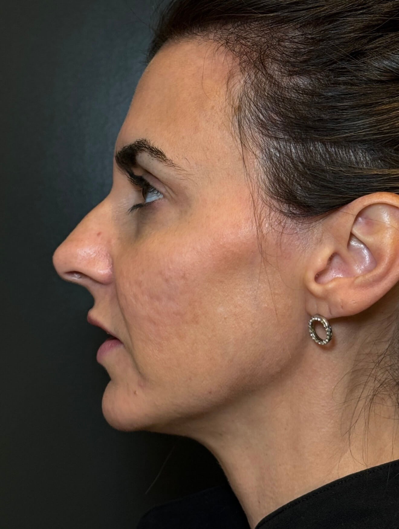 Tribrid Laser Rejuvenation Before