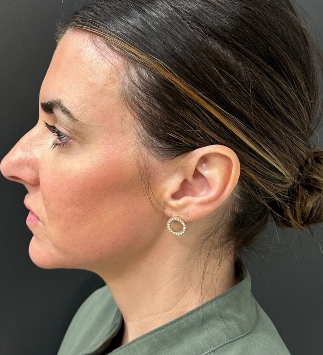 Tribrid Laser Rejuvenation After