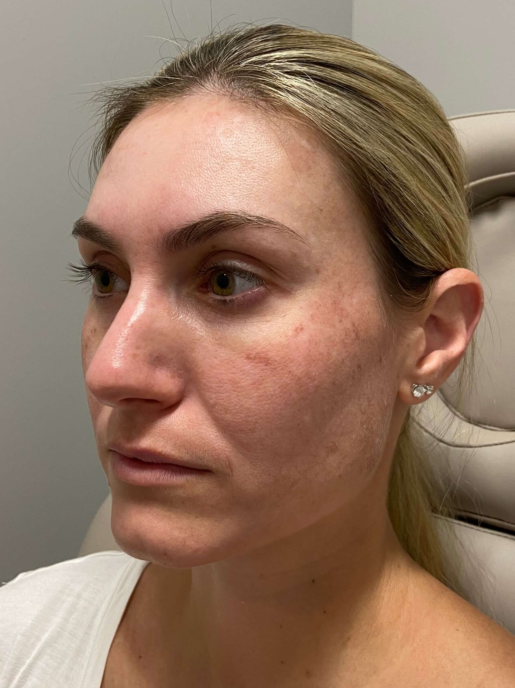 Vampire Facelift / Lip Filler Before