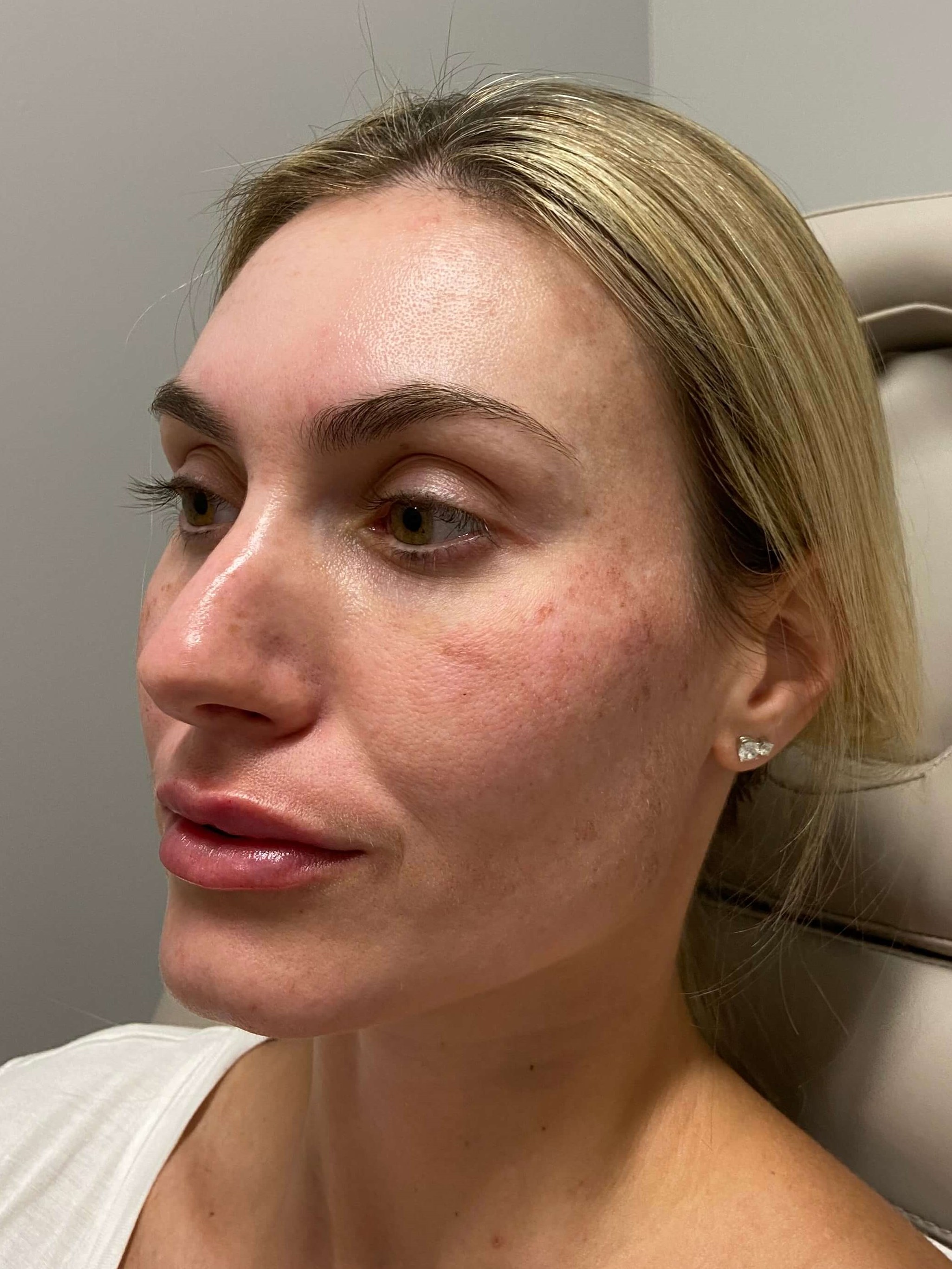 Vampire Facelift / Lip Filler After